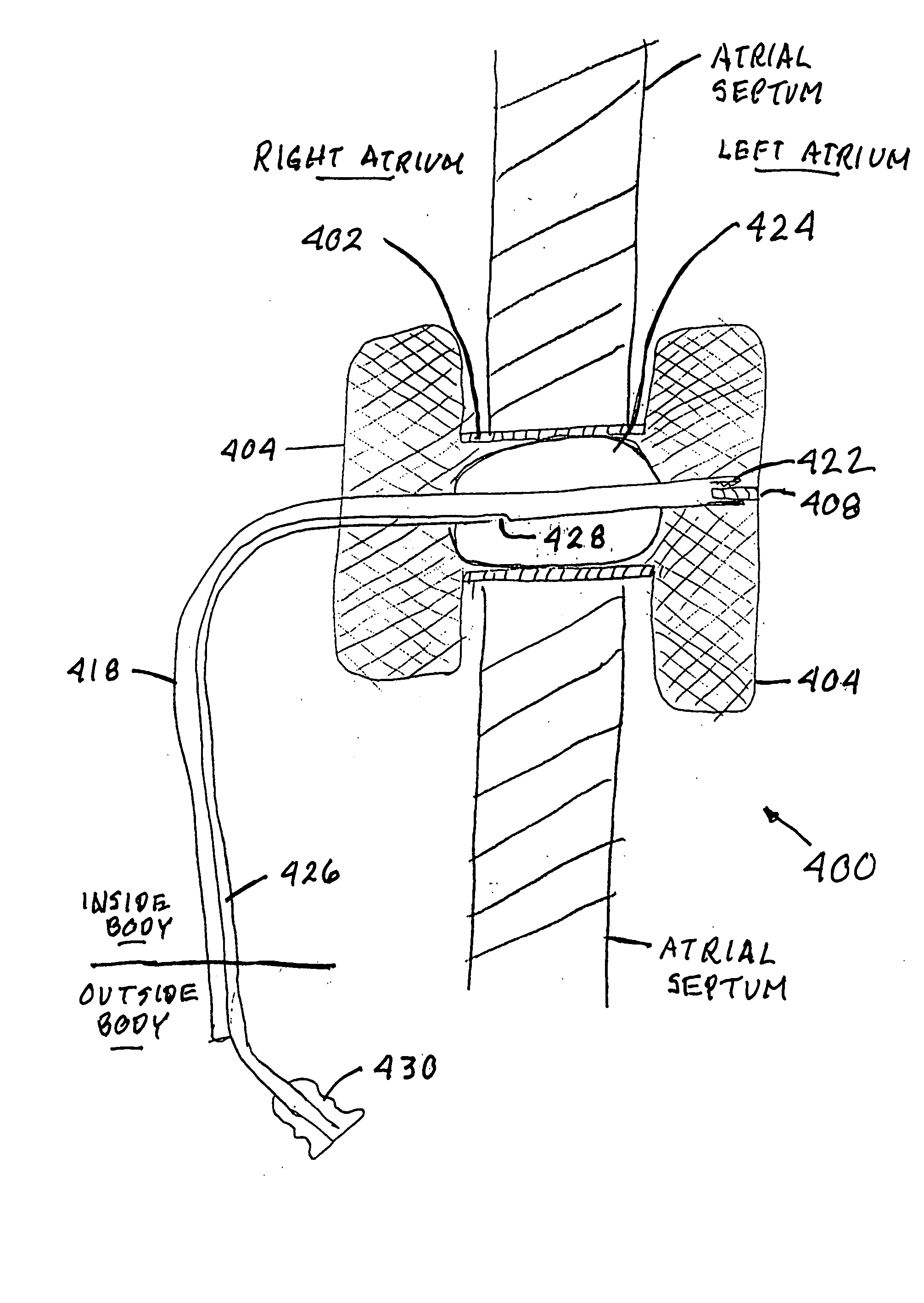 Method and apparatus for treating heart failure