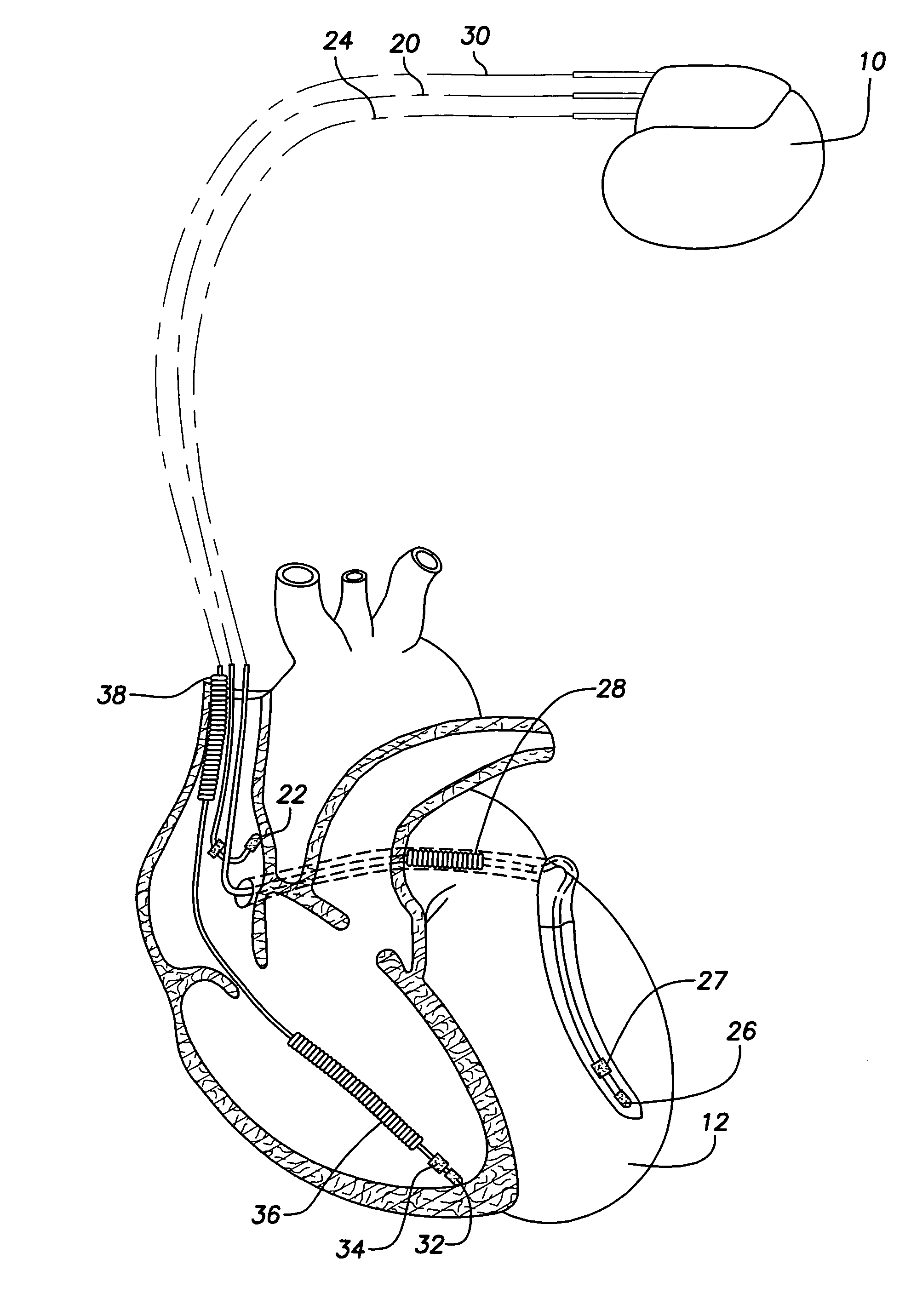 Implantable cardiac stimulation device and method that discriminates between and treats ventricular tachycardia and ventricular fibrillation