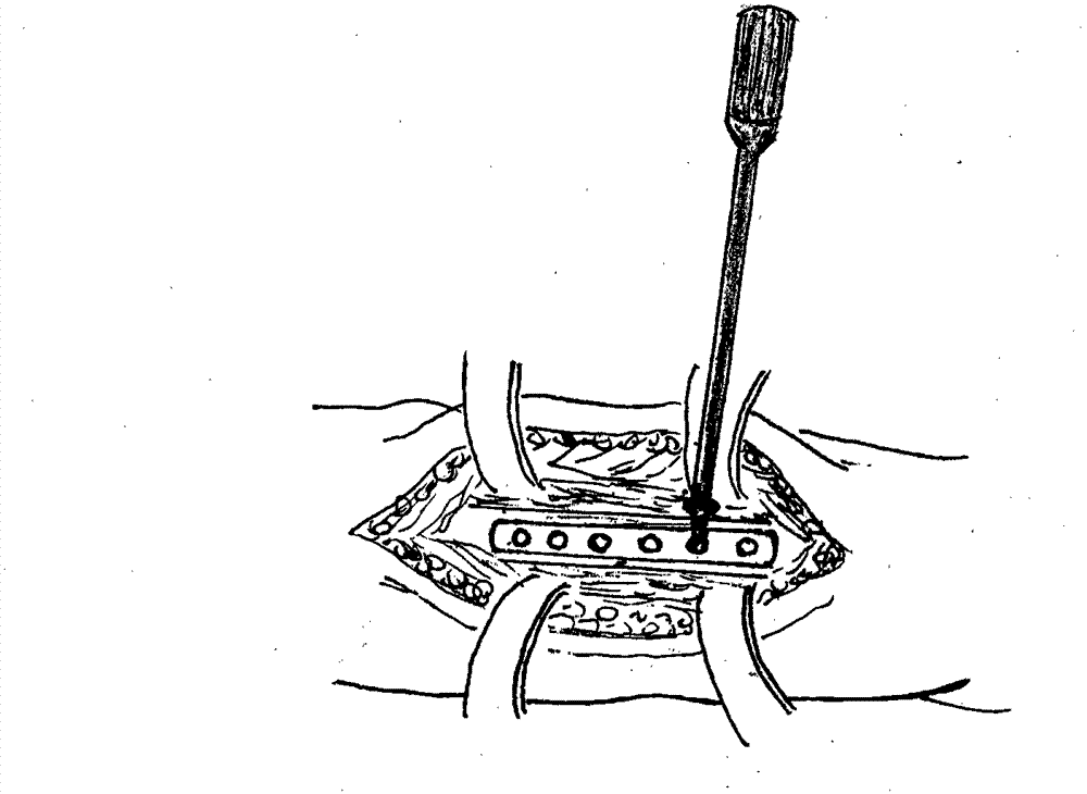 Bone fracture plate screw positioning device
