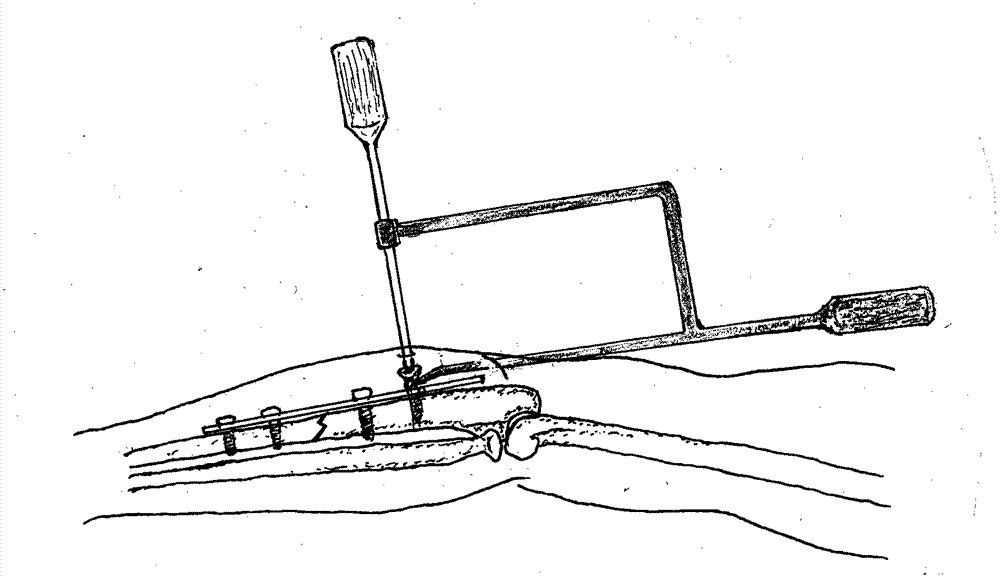 Bone fracture plate screw positioning device