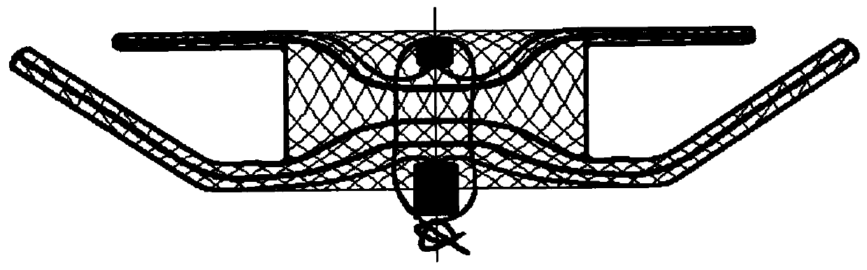 Bronchial fistula closure device