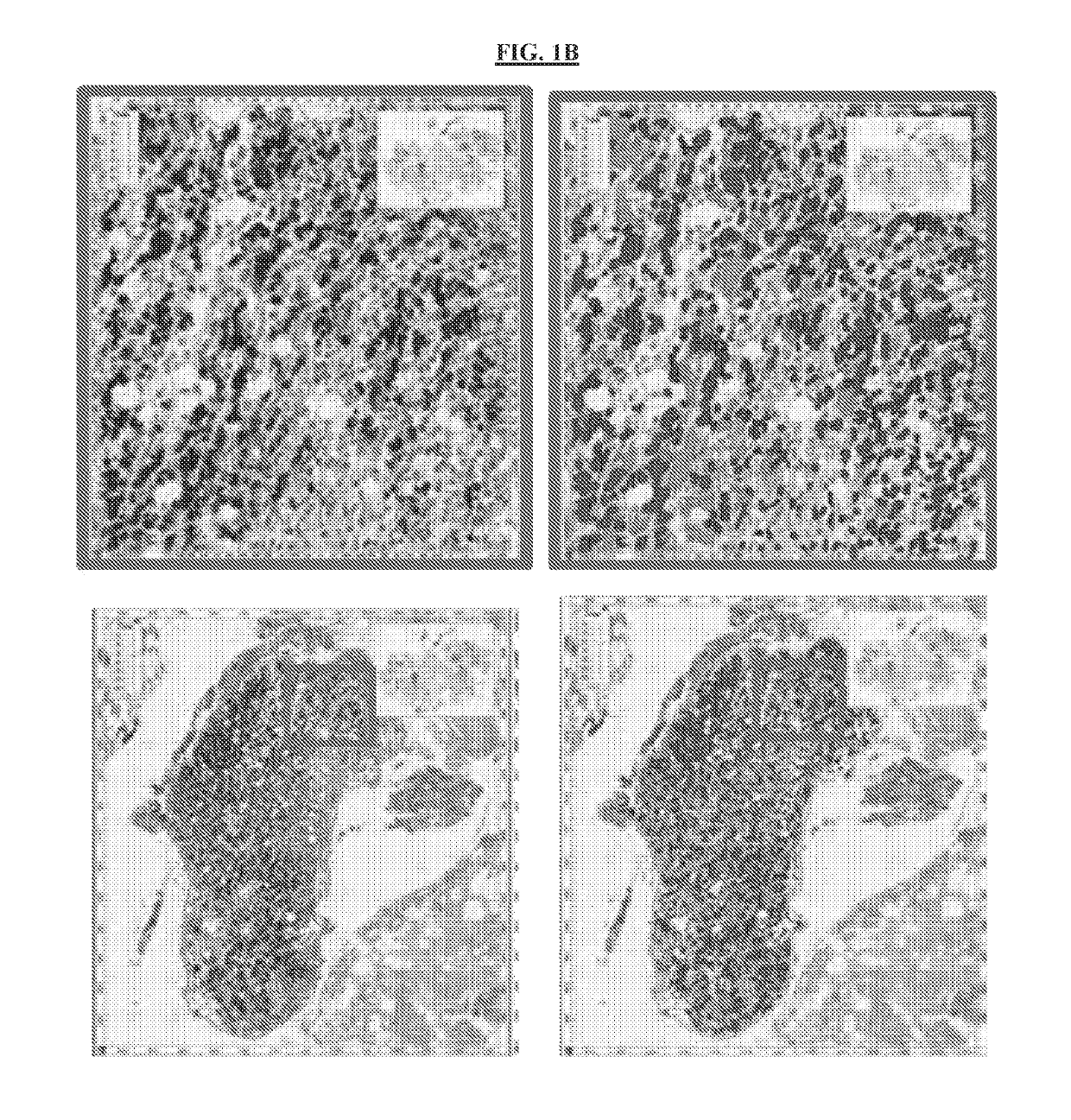 Method of treating androgen receptor negative prostate tumors and their metastases