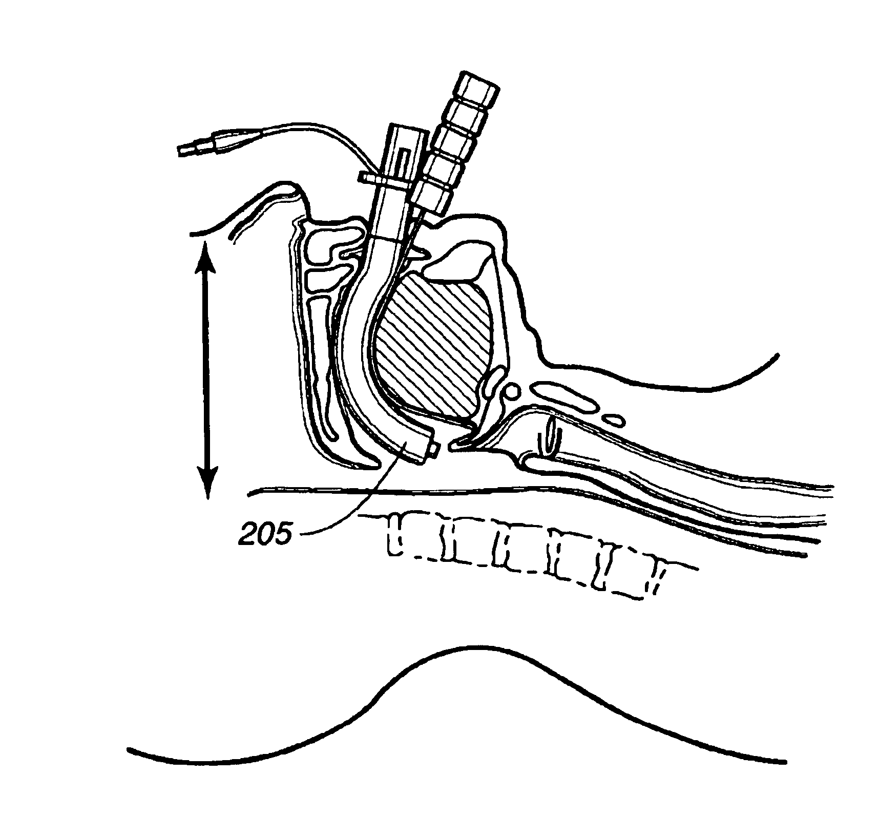 Superglottic and peri-laryngeal apparatus for supraglottic airway insertion