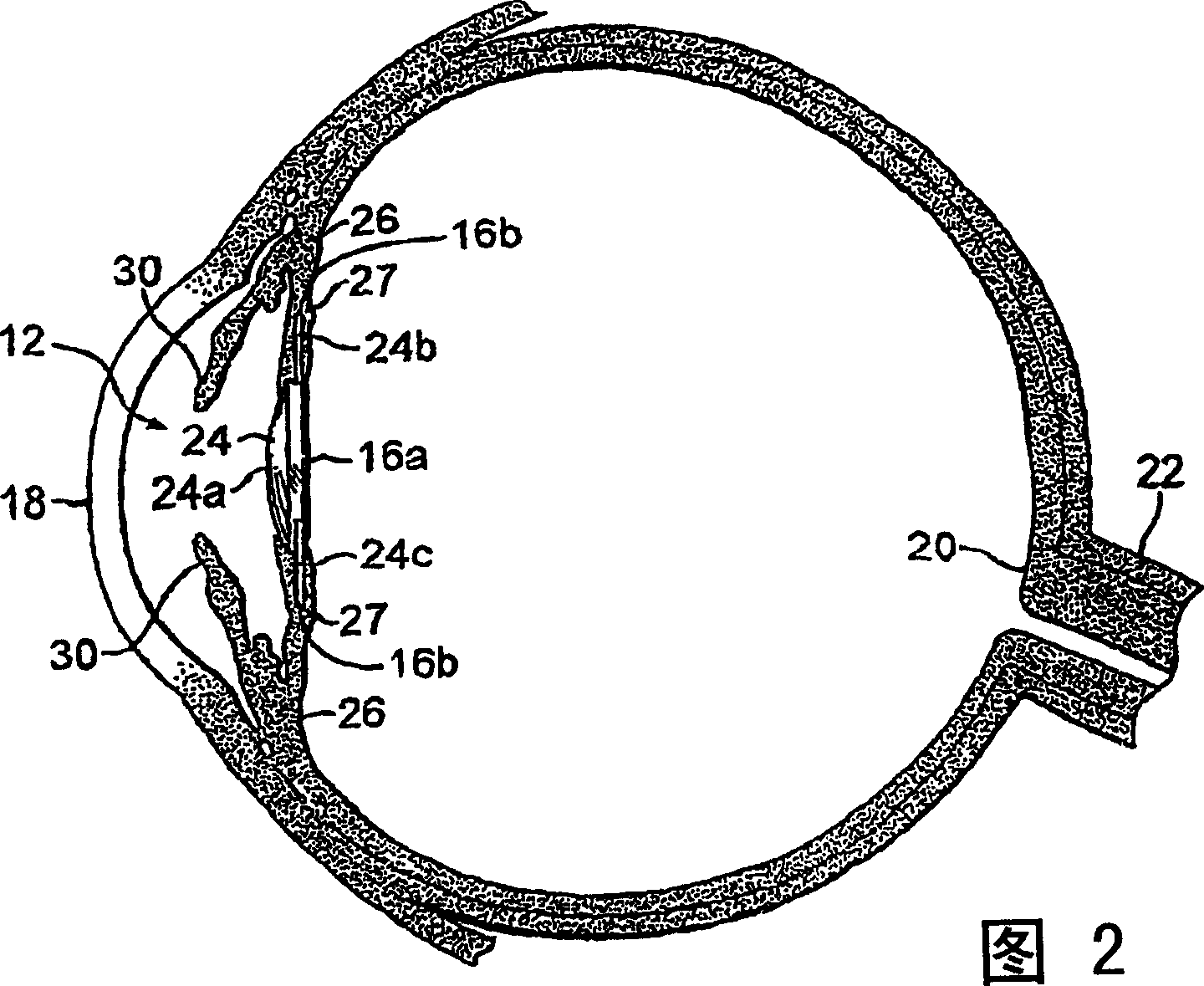 Intraocular lens for inhibiting pco and aco