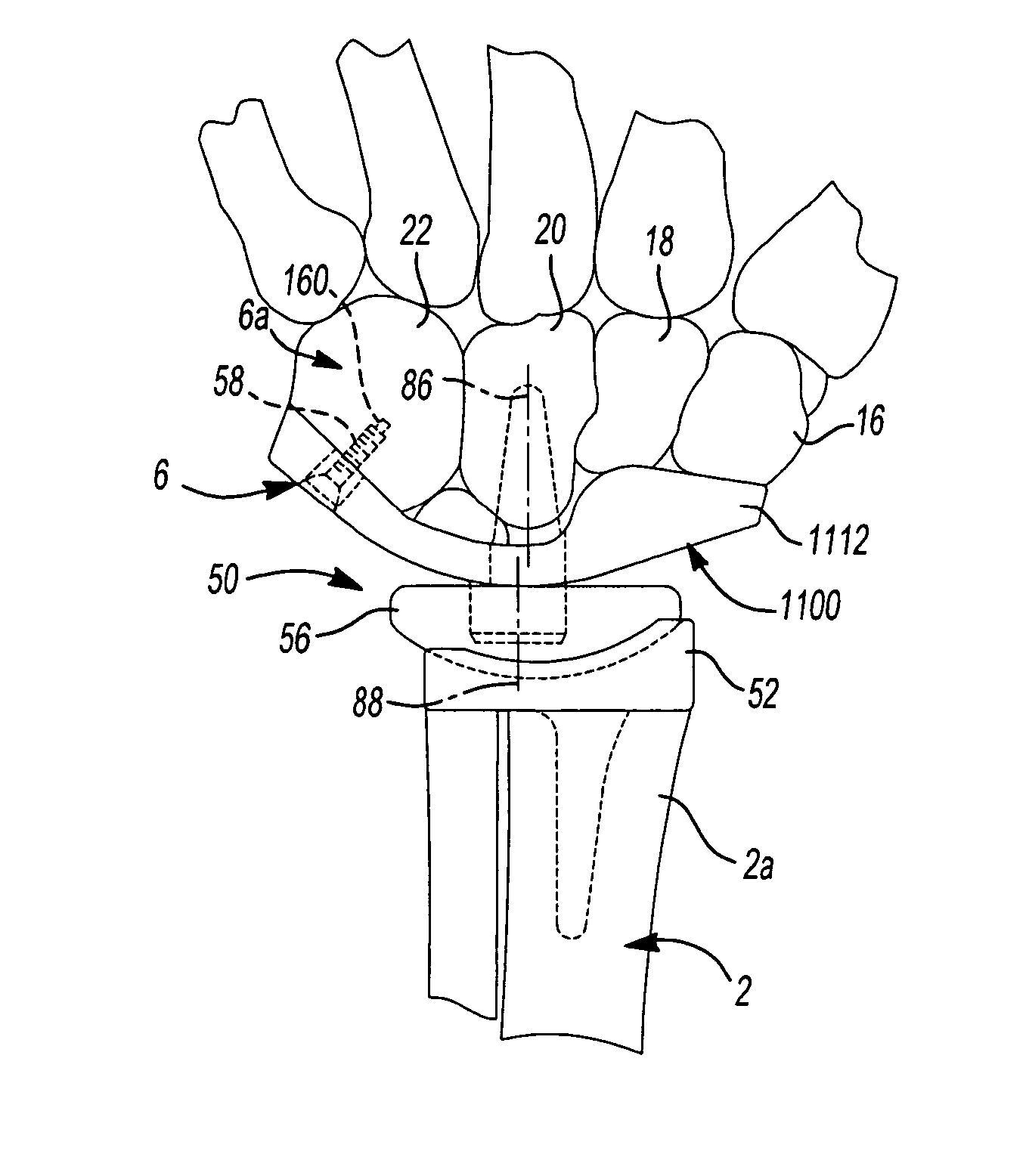 Method and apparatus for wrist arthroplasty