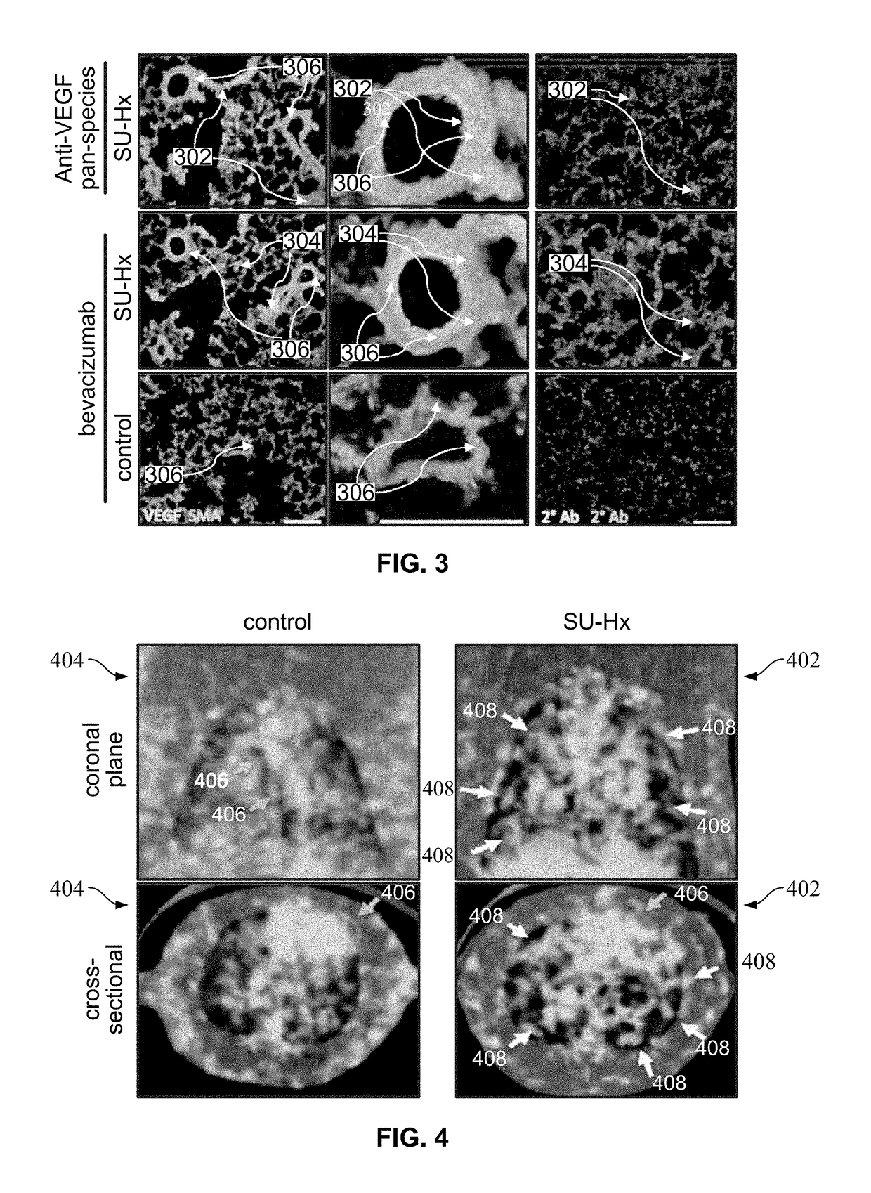 Imaging probe for angiogenic activity in pulmonary arterial hypertension