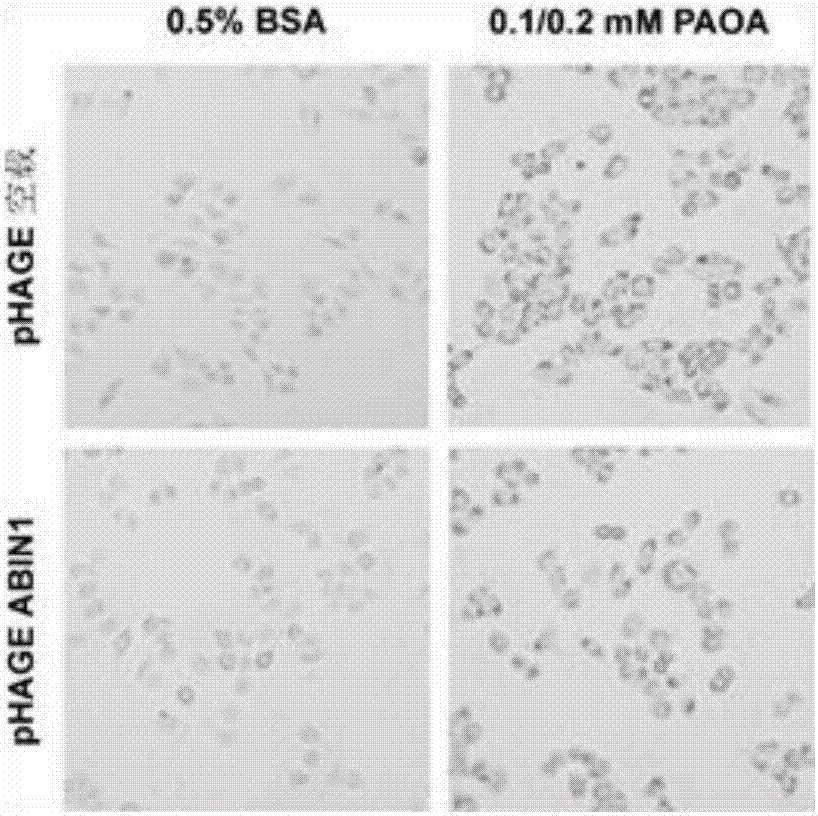 Application of nuclear factor chiB inhibition protein 1 combined with A20 to preparation of medicine for treating fatty livers and related diseases