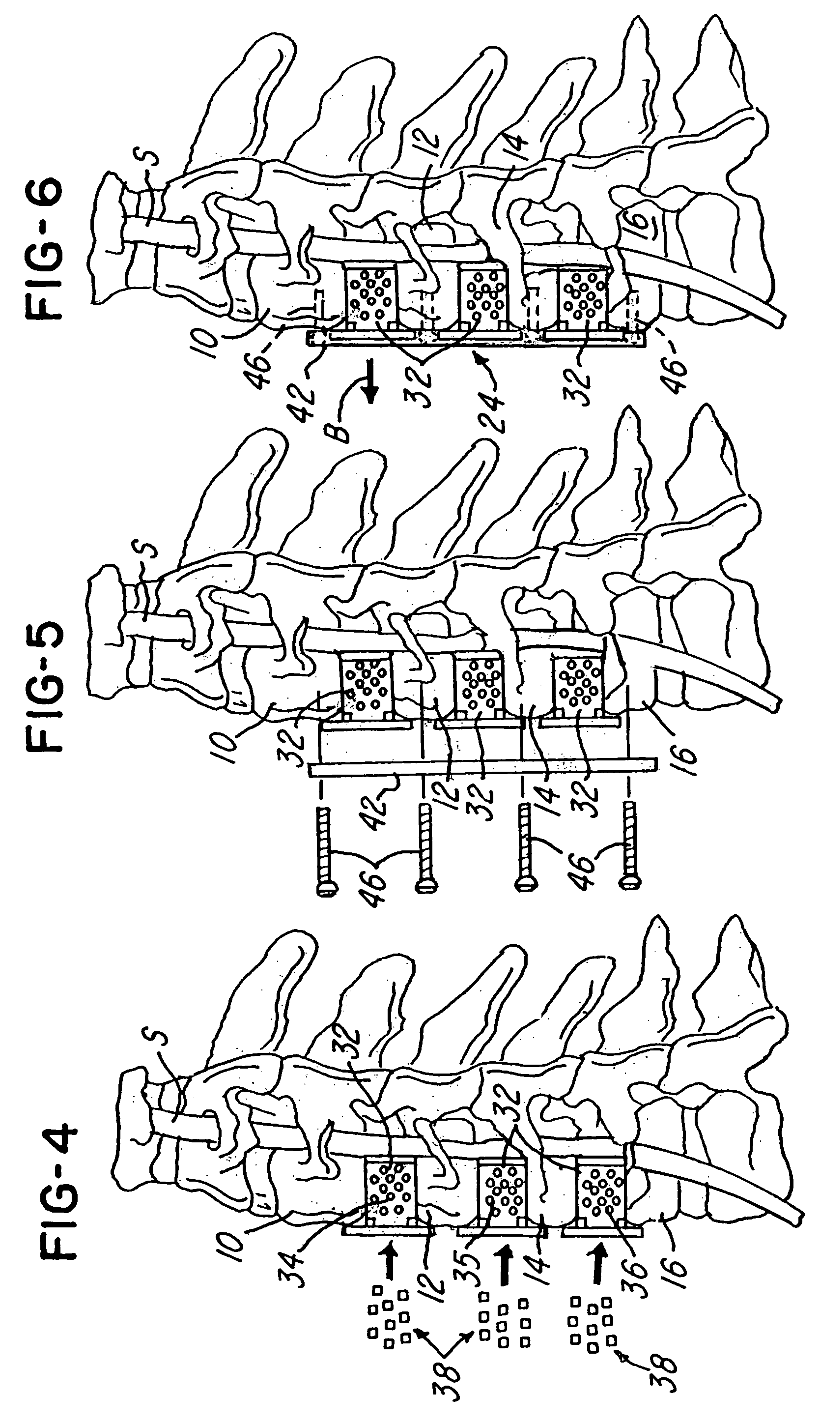 Spinal fusion system and method for fusing spinal bones