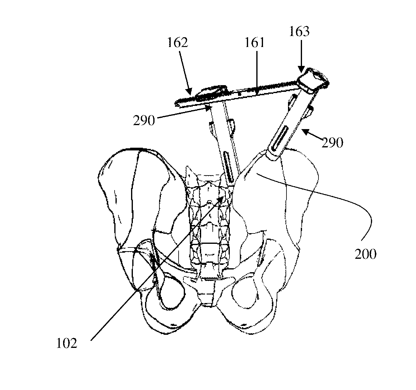 Method and implant system for sacroiliac joint fixation and fusion