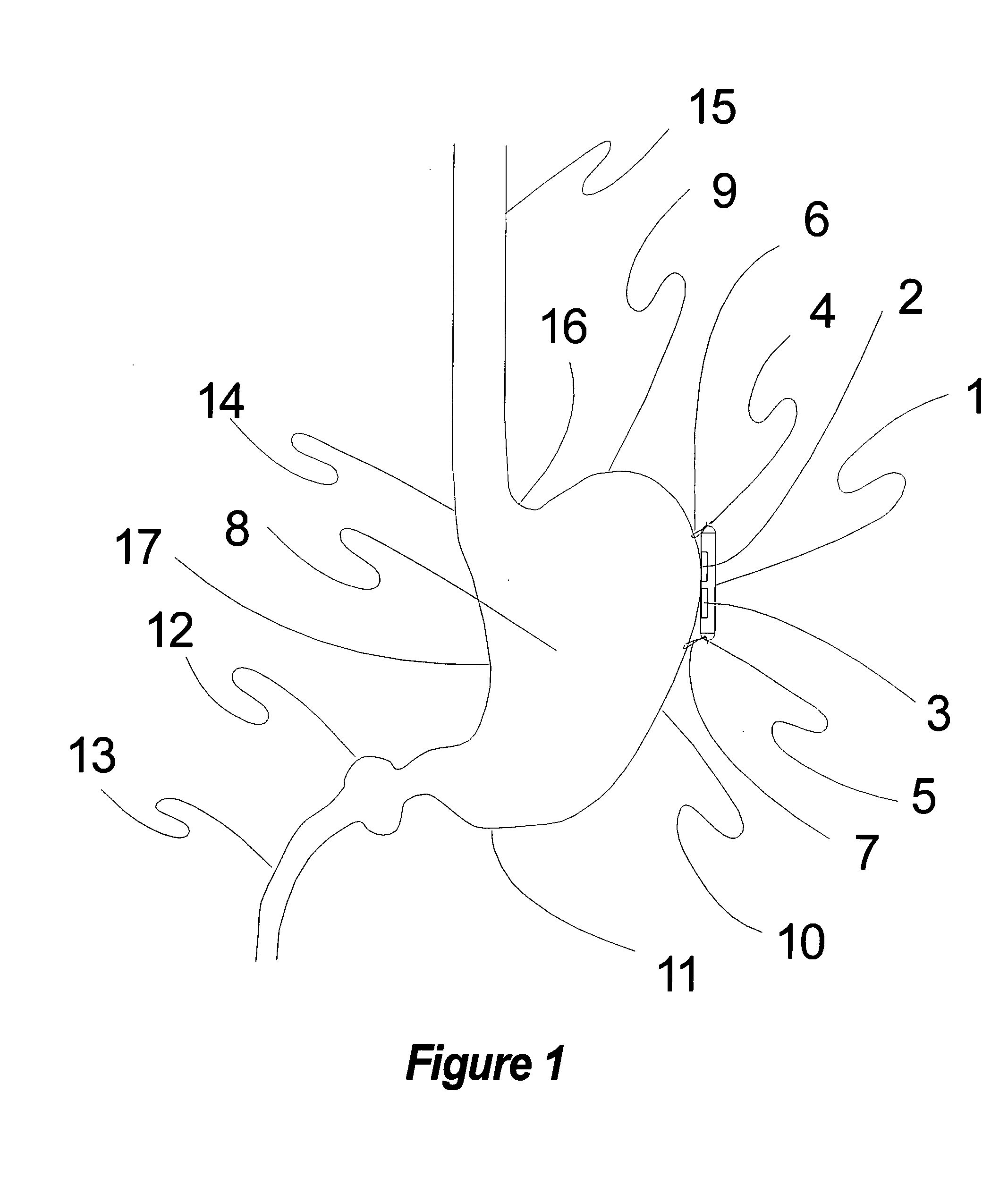 Method, apparatus, and surgical technique for autonomic neuromodulation for the treatment of disease