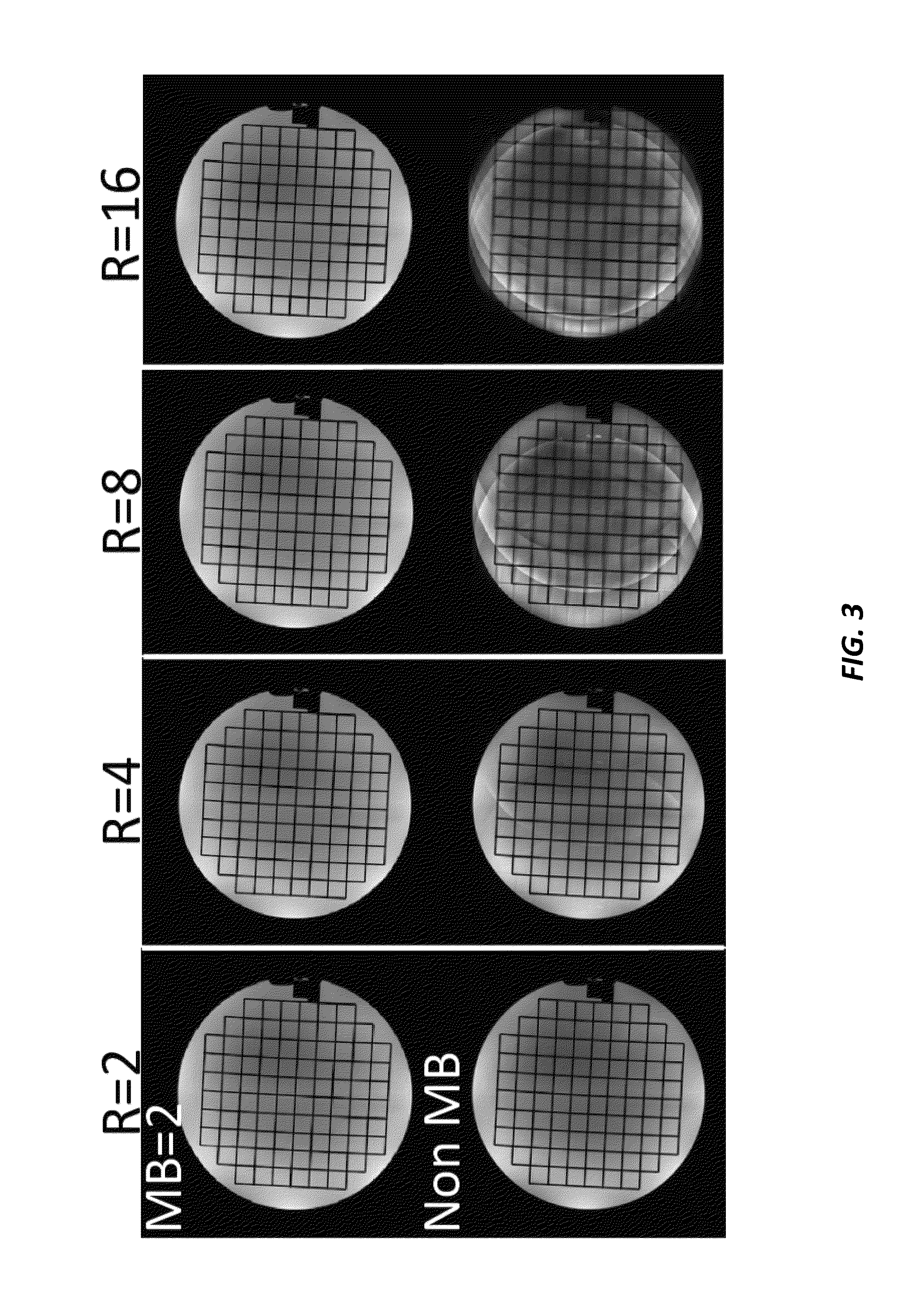 High Resolution Magnetic Resonance Imaging with Reduced Distortion Based on Reduced-Field-of-View and Generalized Parallel Imaging