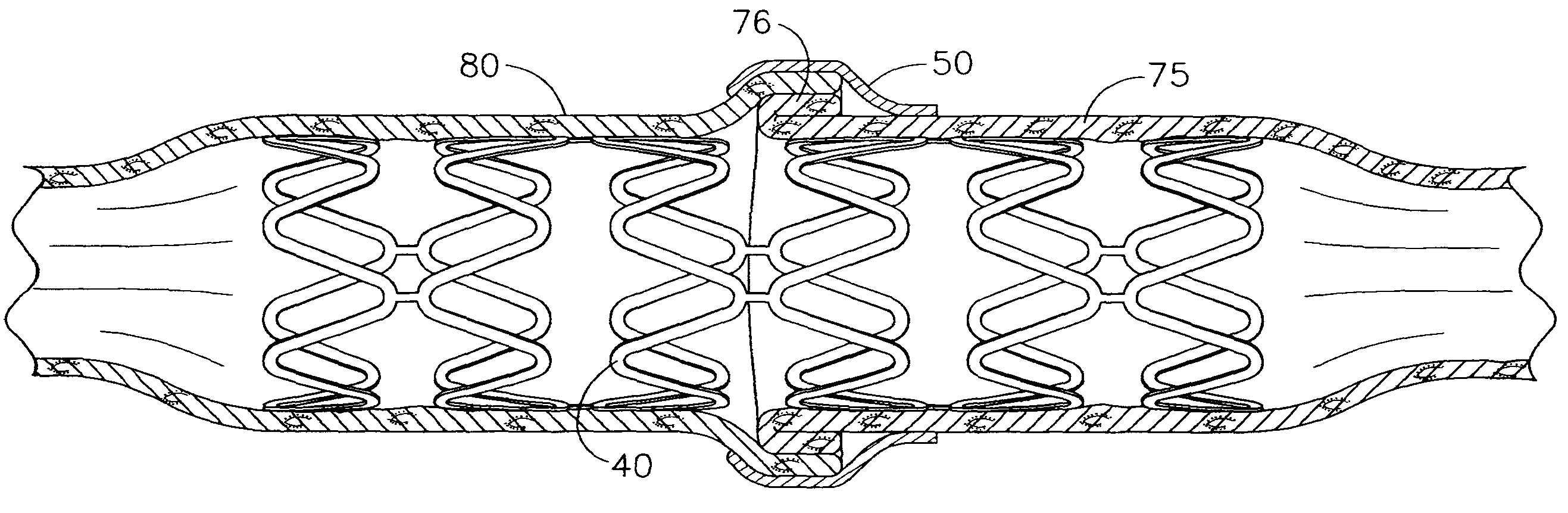 Method of performing an end-to-end anastomosis using a stent and an adhesive