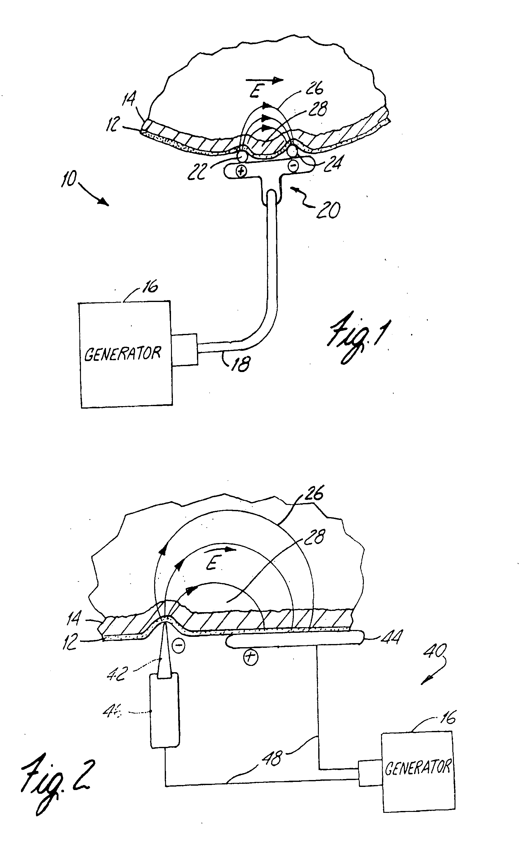 Apparatus and method for reducing subcutaneous fat deposits, virtual face lift and body sculpturing by electroporation