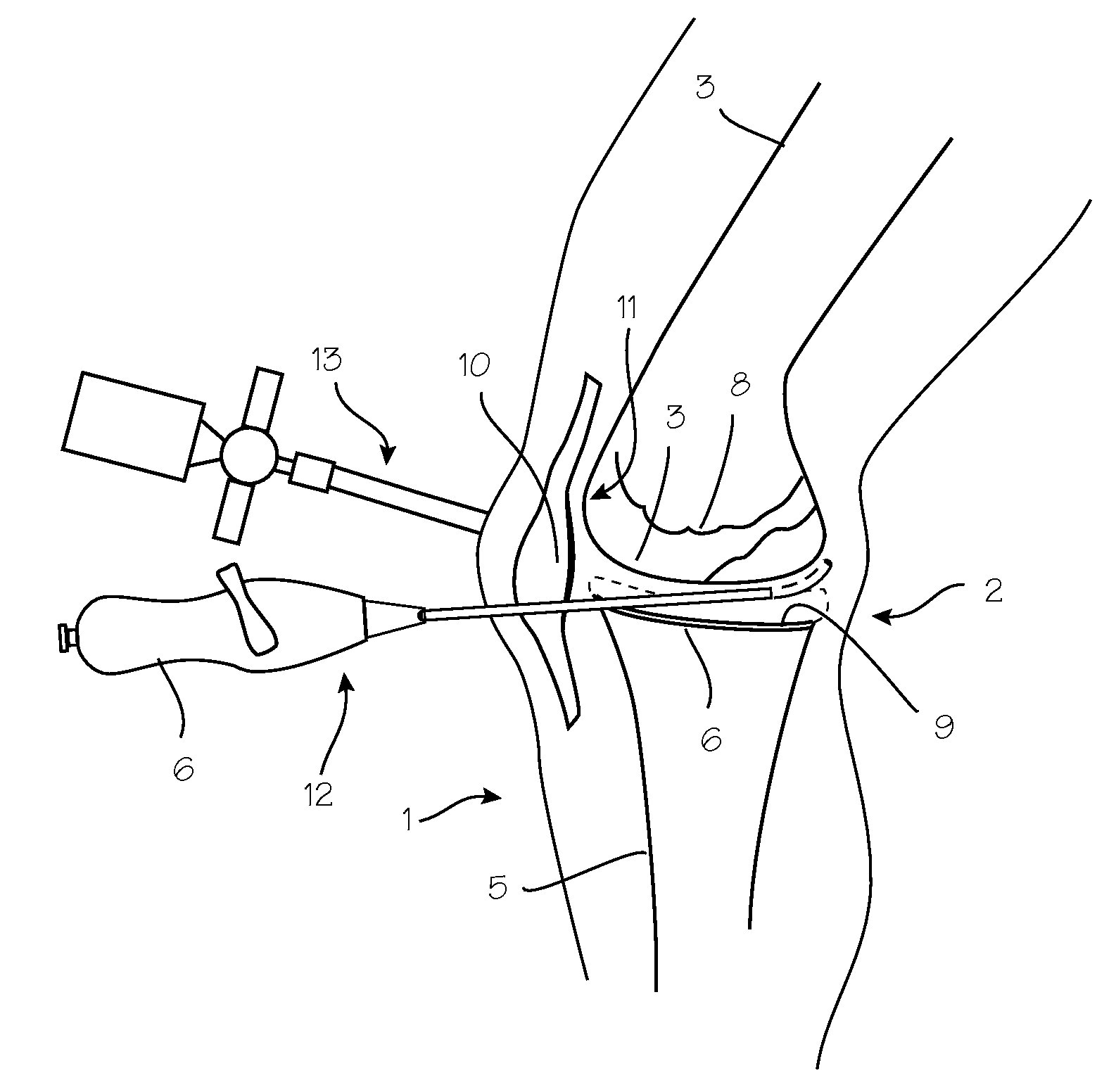 Method and Devices for Treating Damaged Articular Cartilage
