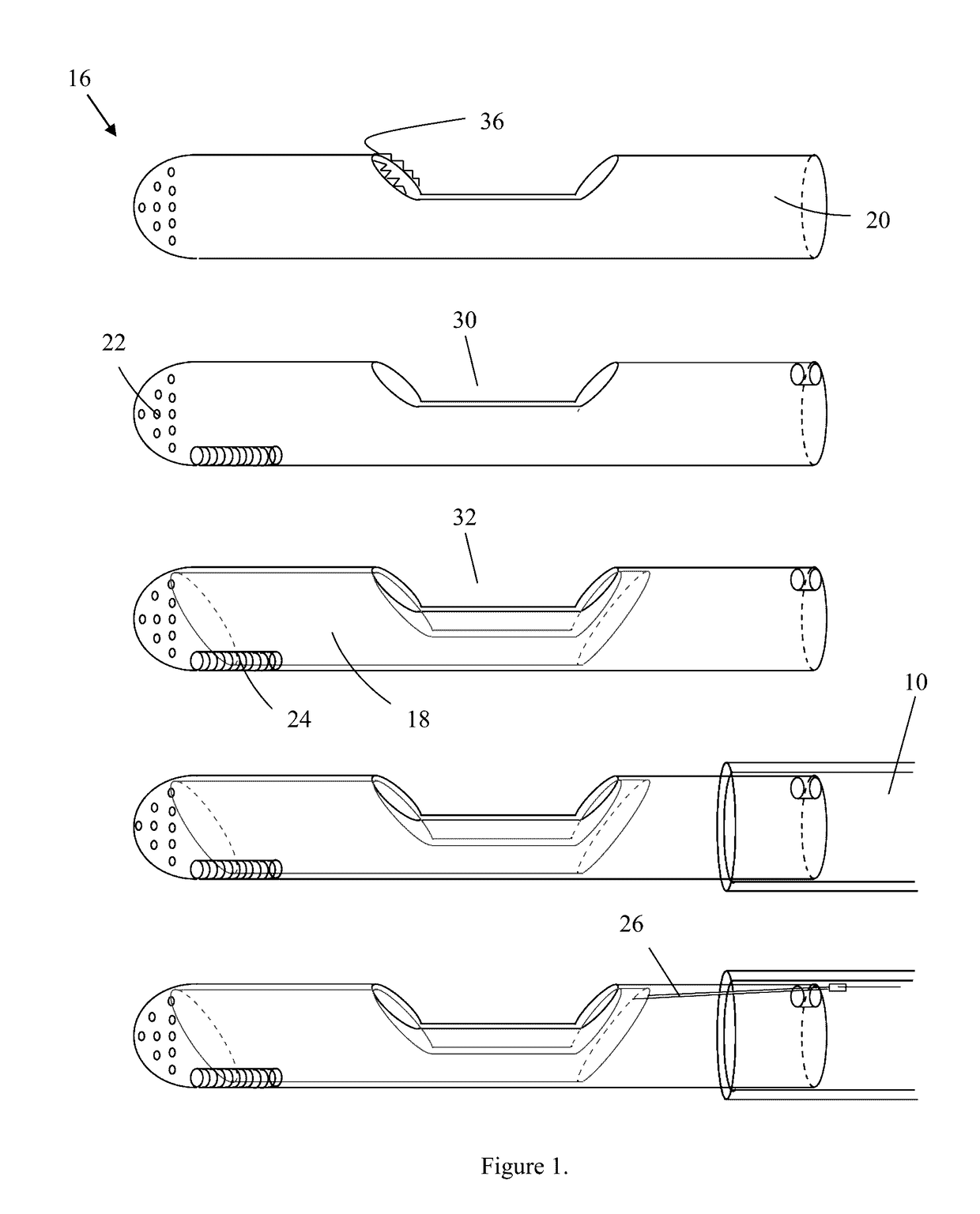 Device for the treatment of hypertrophic cardiomyopathy