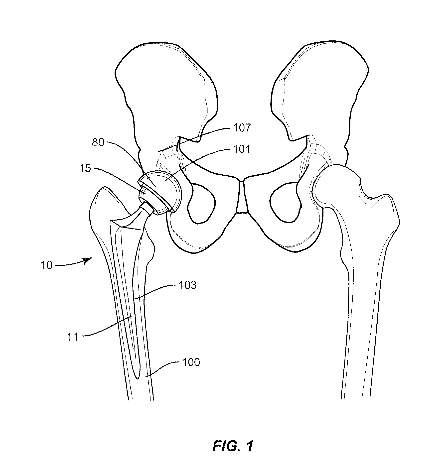 Methods and Devices for a Surgical Hip Replacement Procedure