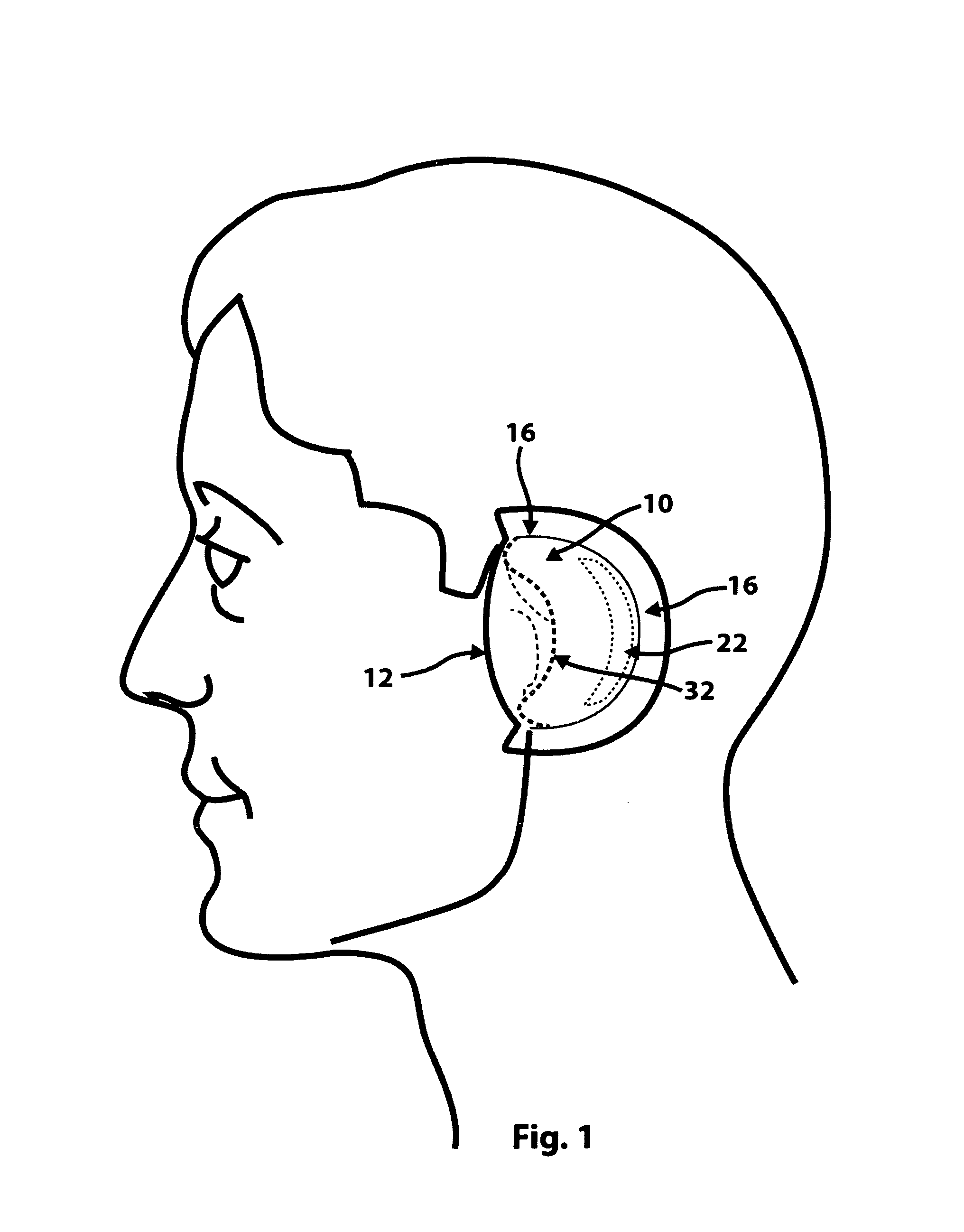 Ear-mounted lenticular acoustic reflector