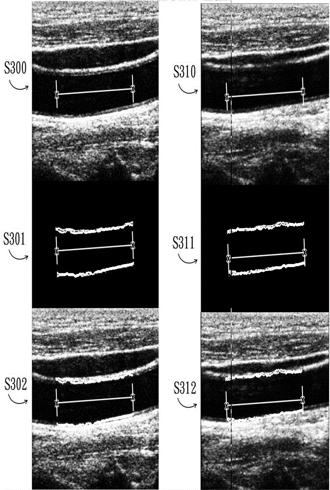 Method and system for rapid and automatic acquisition of vessel edge morphology in dynamic ultrasound images