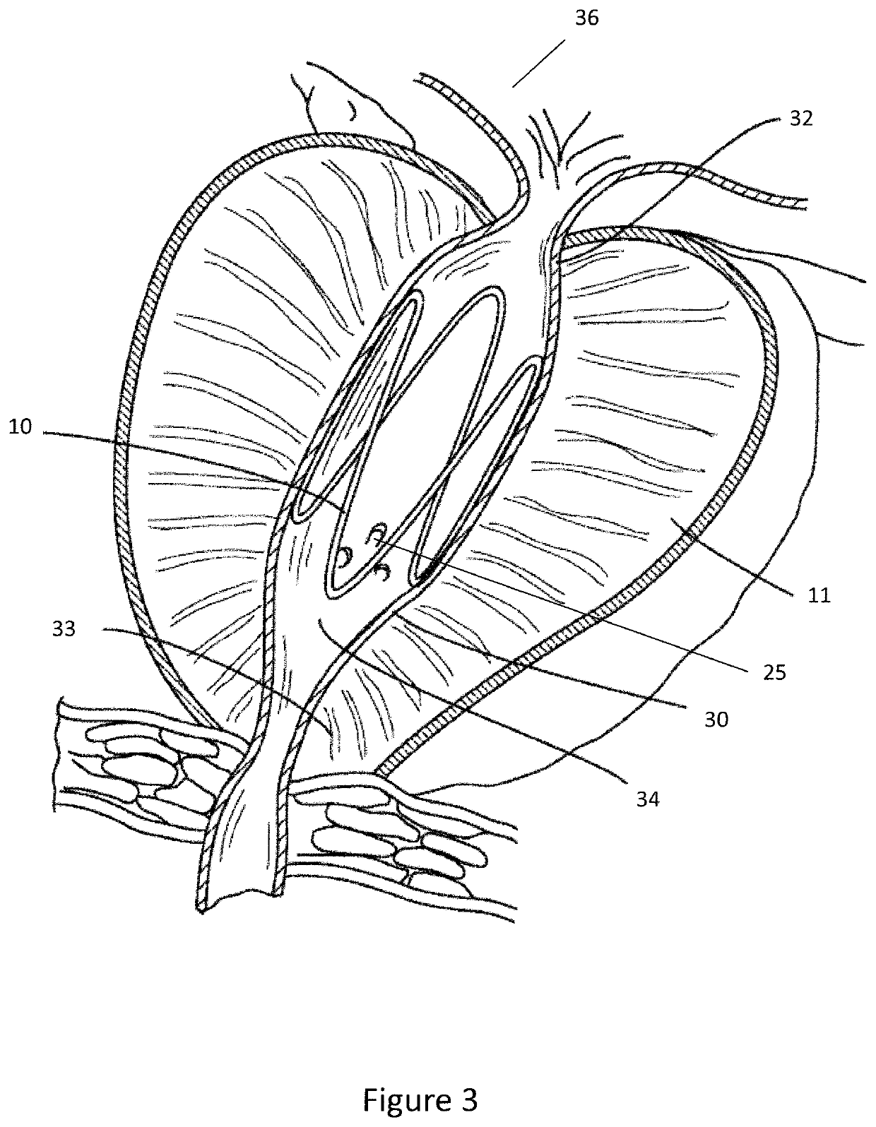 Expandable implant delivery device