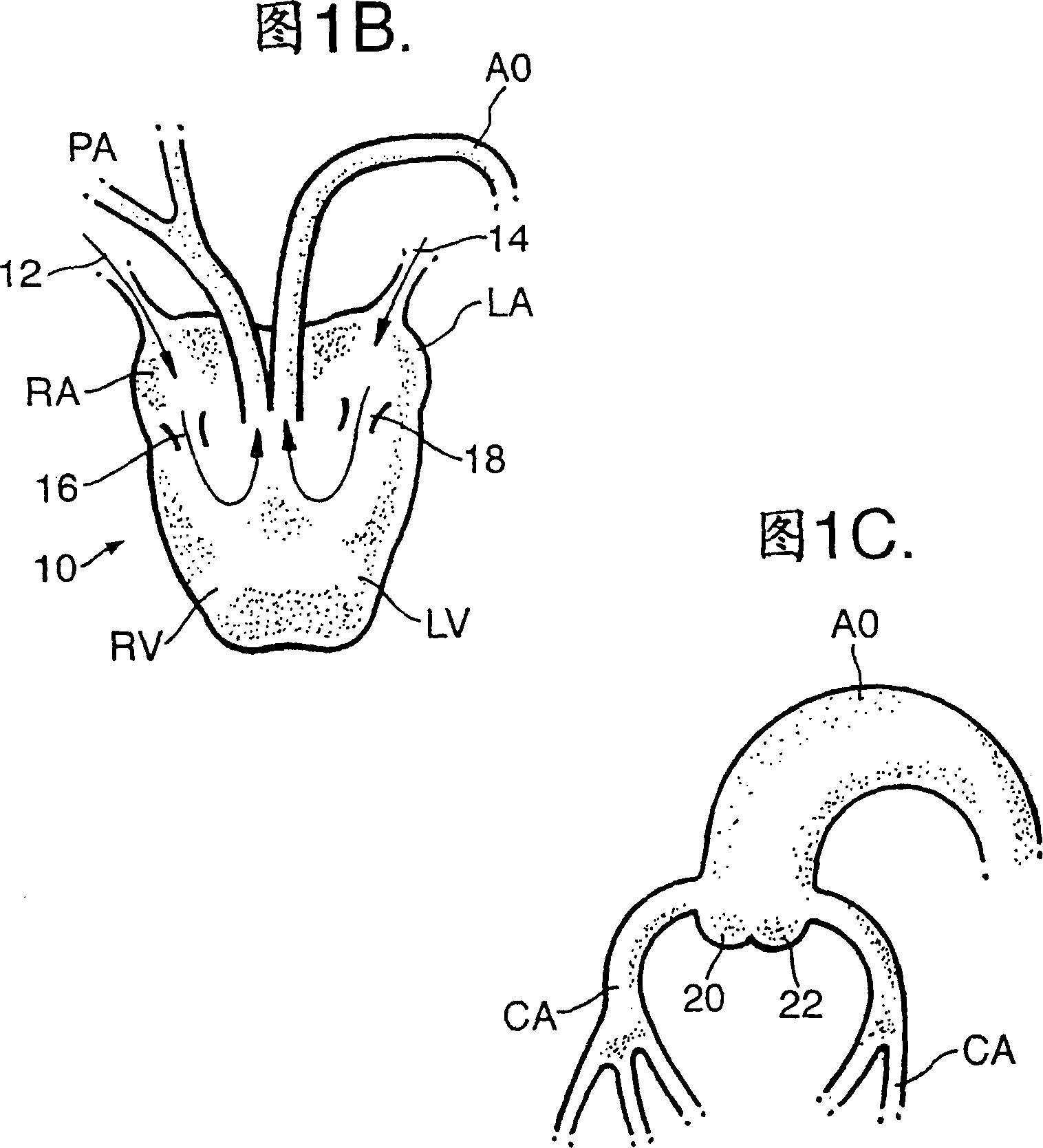 Method of treating a living organism to achieve a heart load reduction, and apparatus for carrying out the method