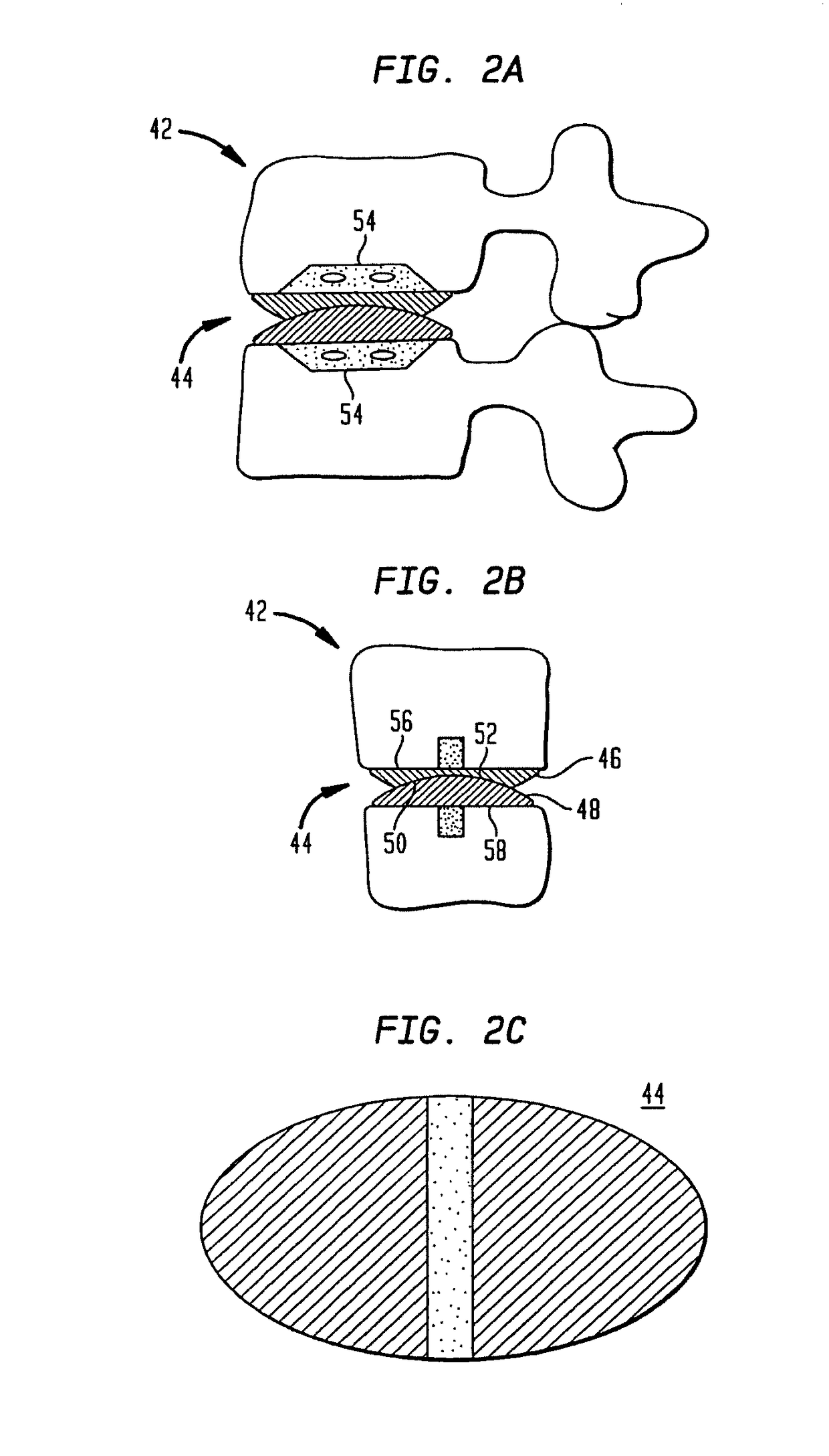 Two-component artificial disc replacements