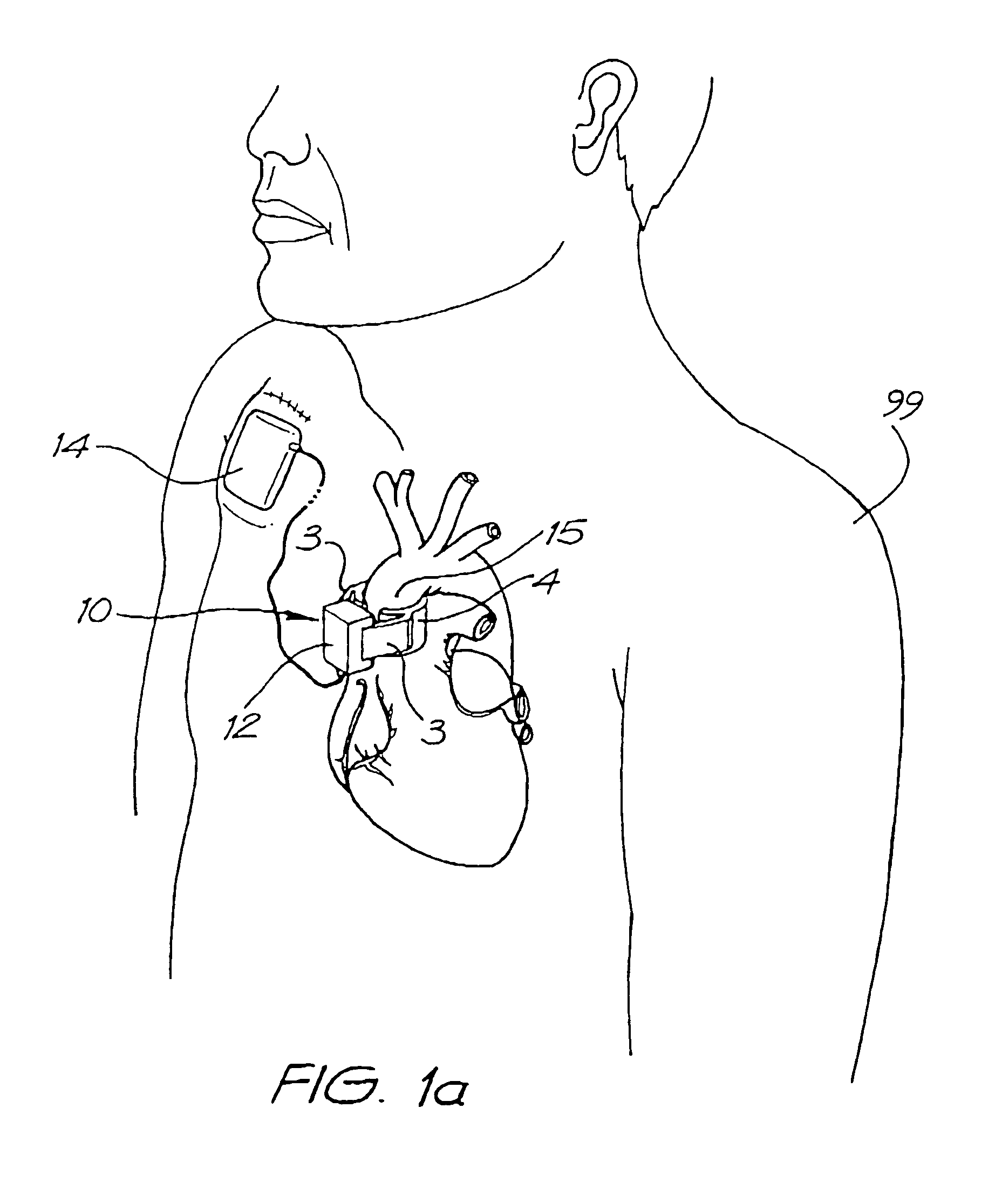 Heart assist devices, systems and methods