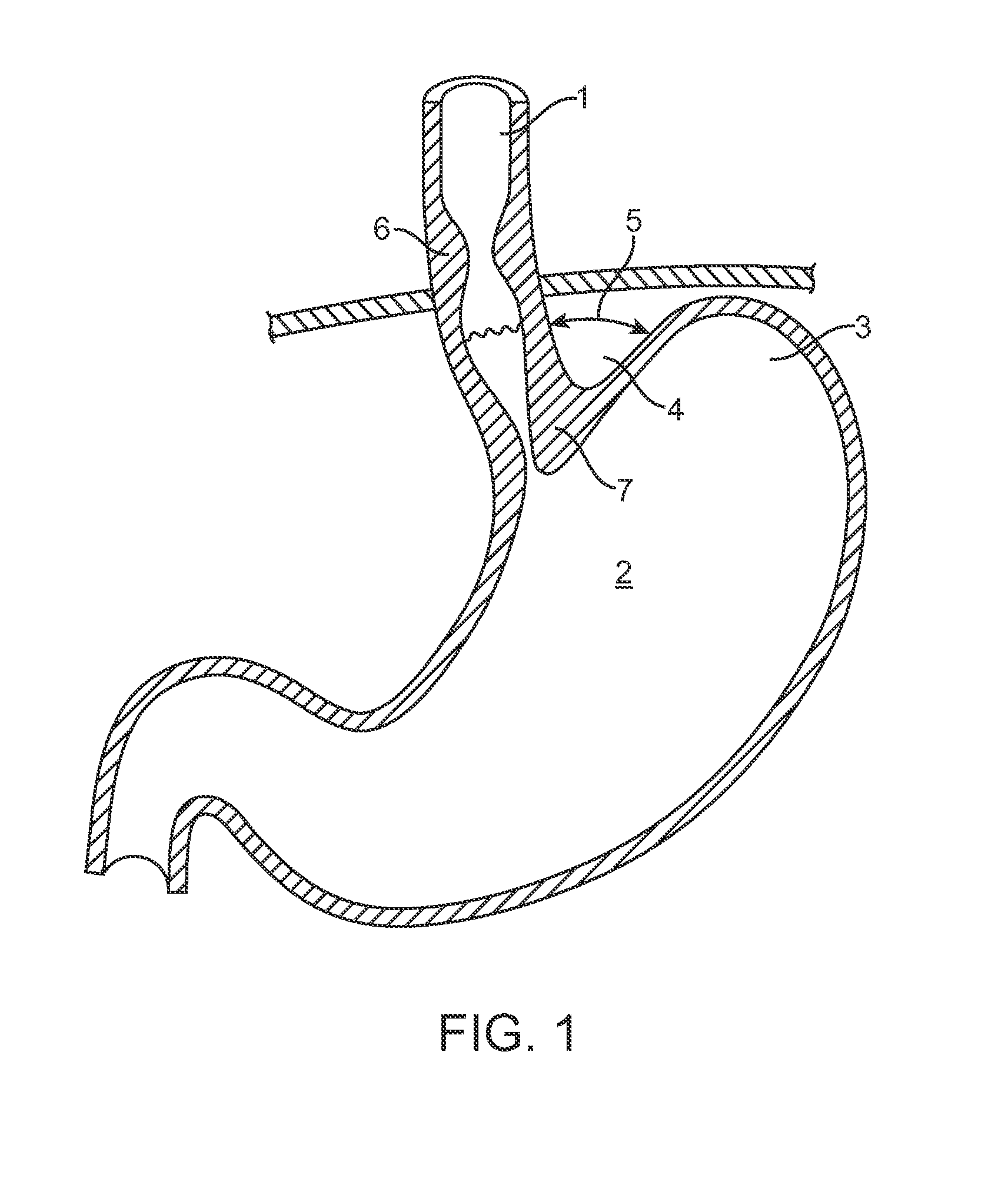 Methods and devices for anchoring to tissue