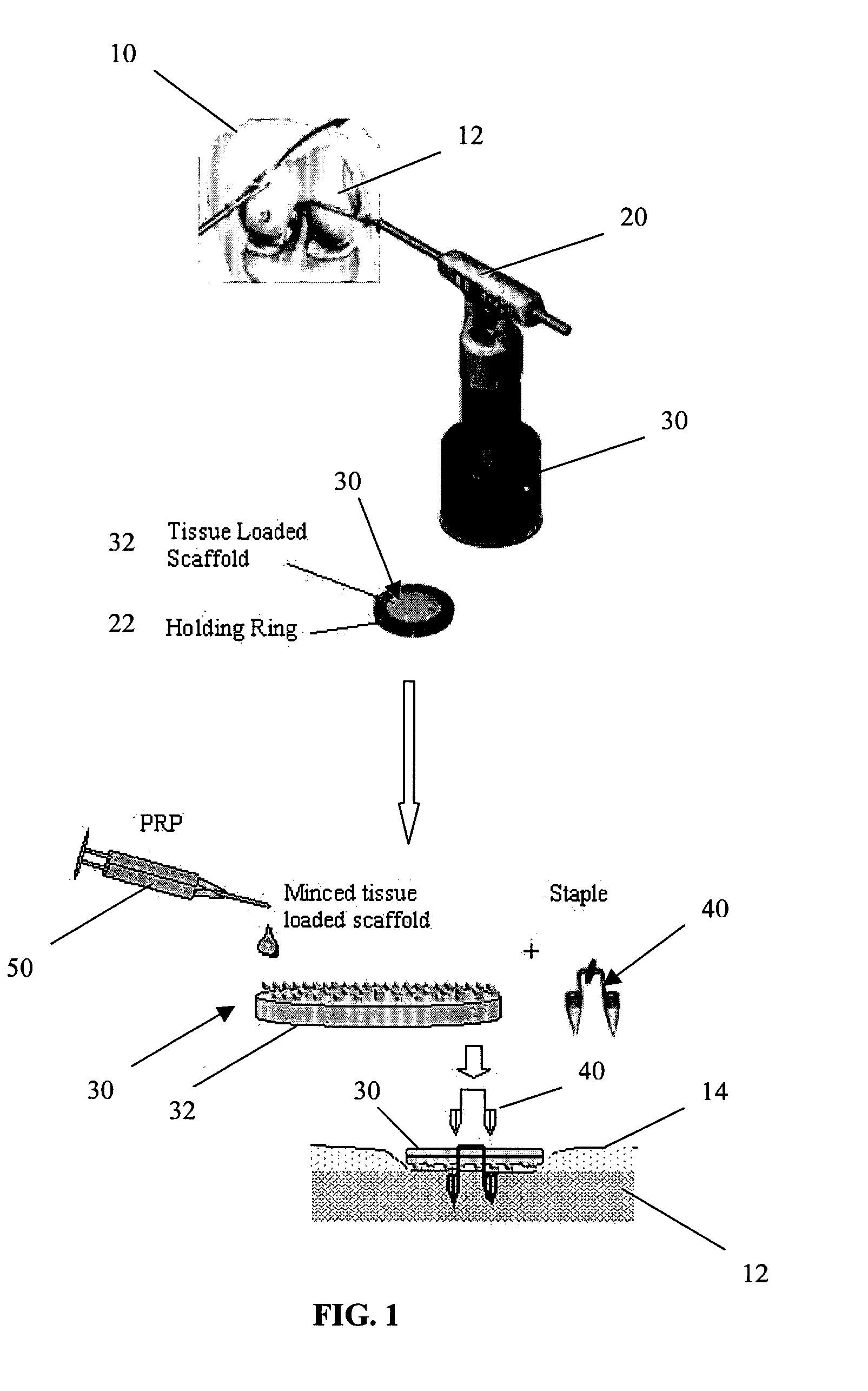 Method and apparatus for resurfacing an articular surface