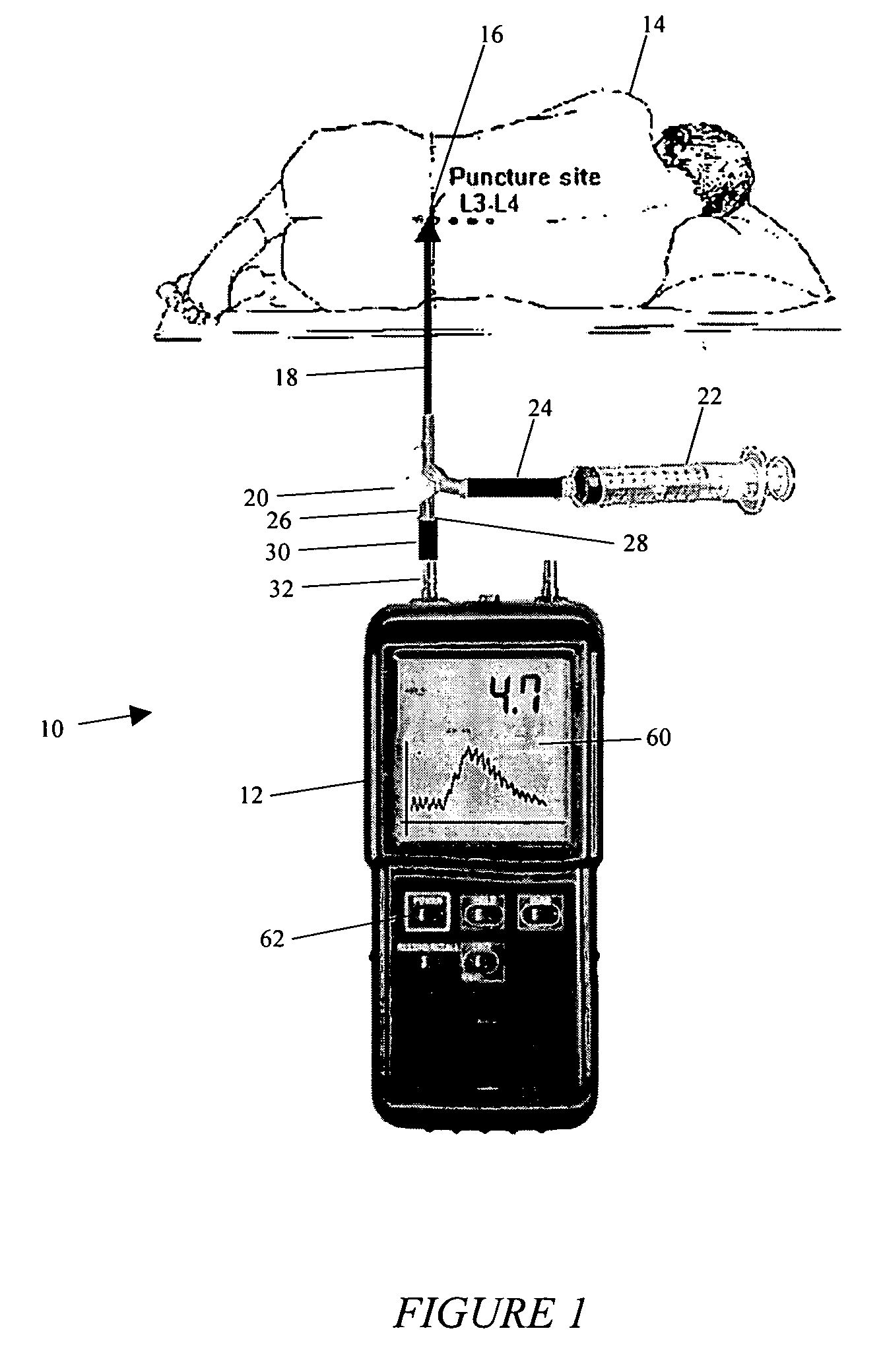 System and method for measuring the pressure of a fluid system within a patient