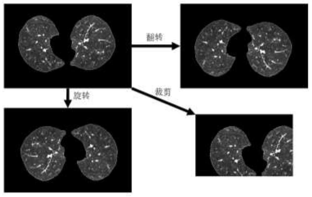 CT image-based interpretable pulmonary tuberculosis classification network identification method