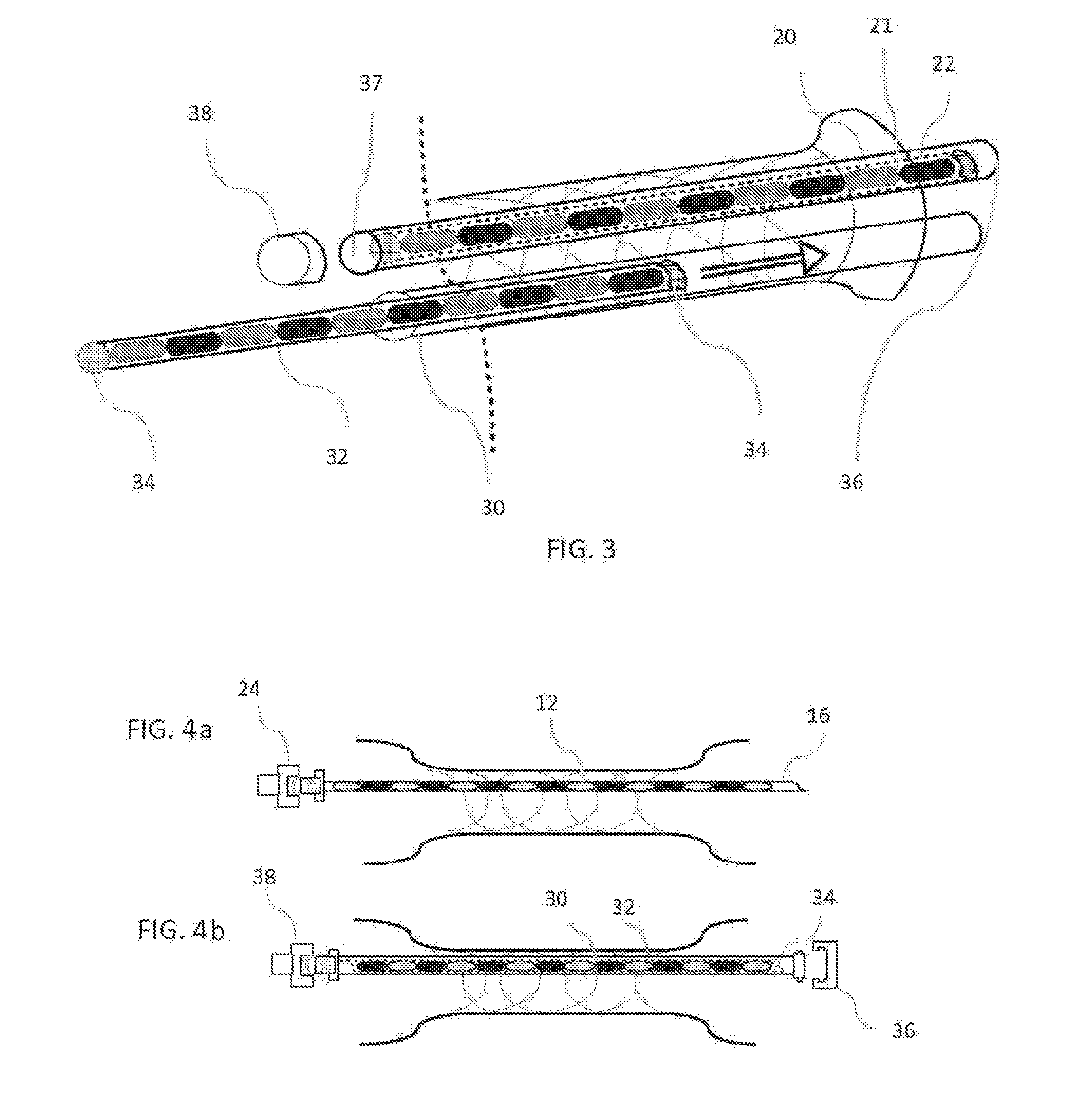 Device and method for improving brachytherapy
