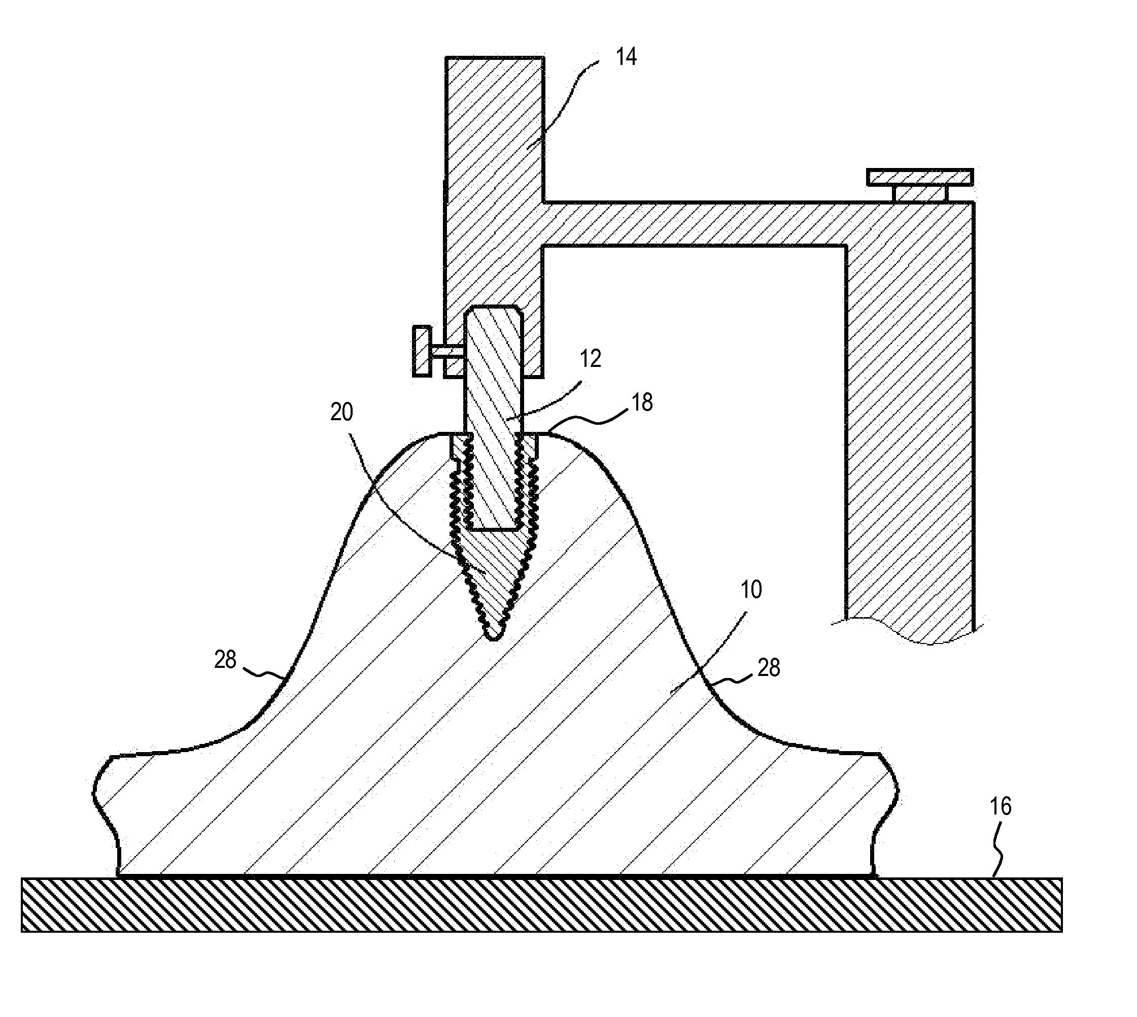 Oral Implant Placement System and Method