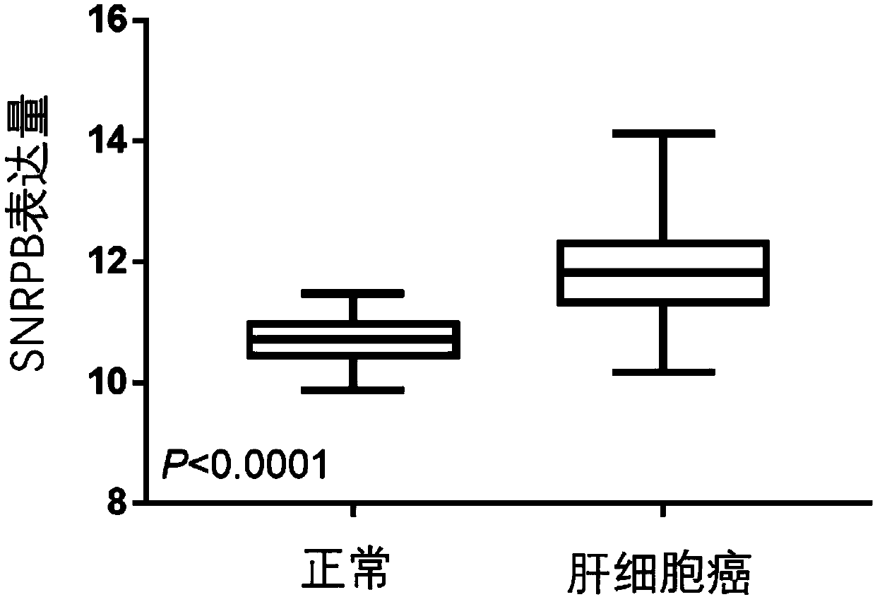 Application of SNRPB as biomarker in prognosis evaluation of hepatocellular carcinoma and kit containing biomarker