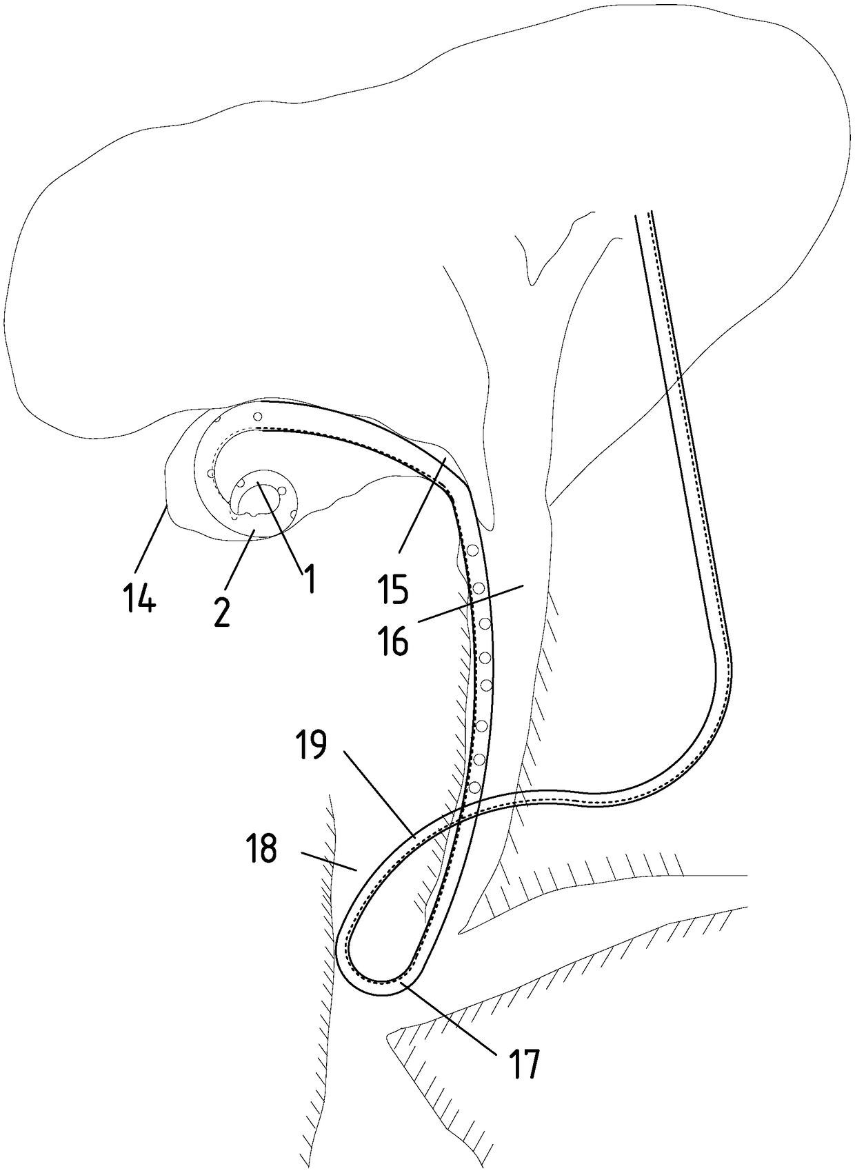External drainage tube for nasal-gallbladder bile