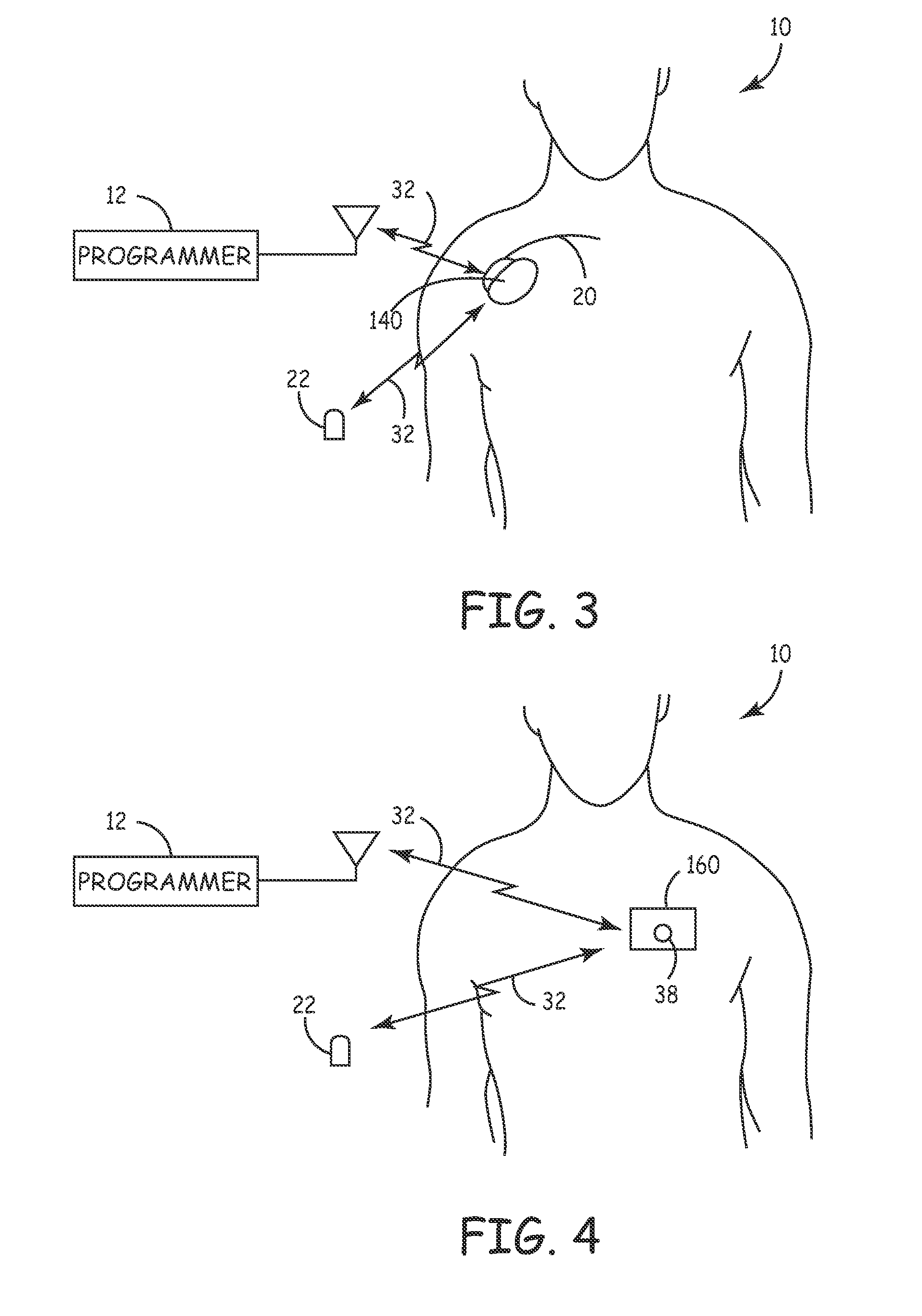 System and method for segmenting a cardiac signal based on brain activity