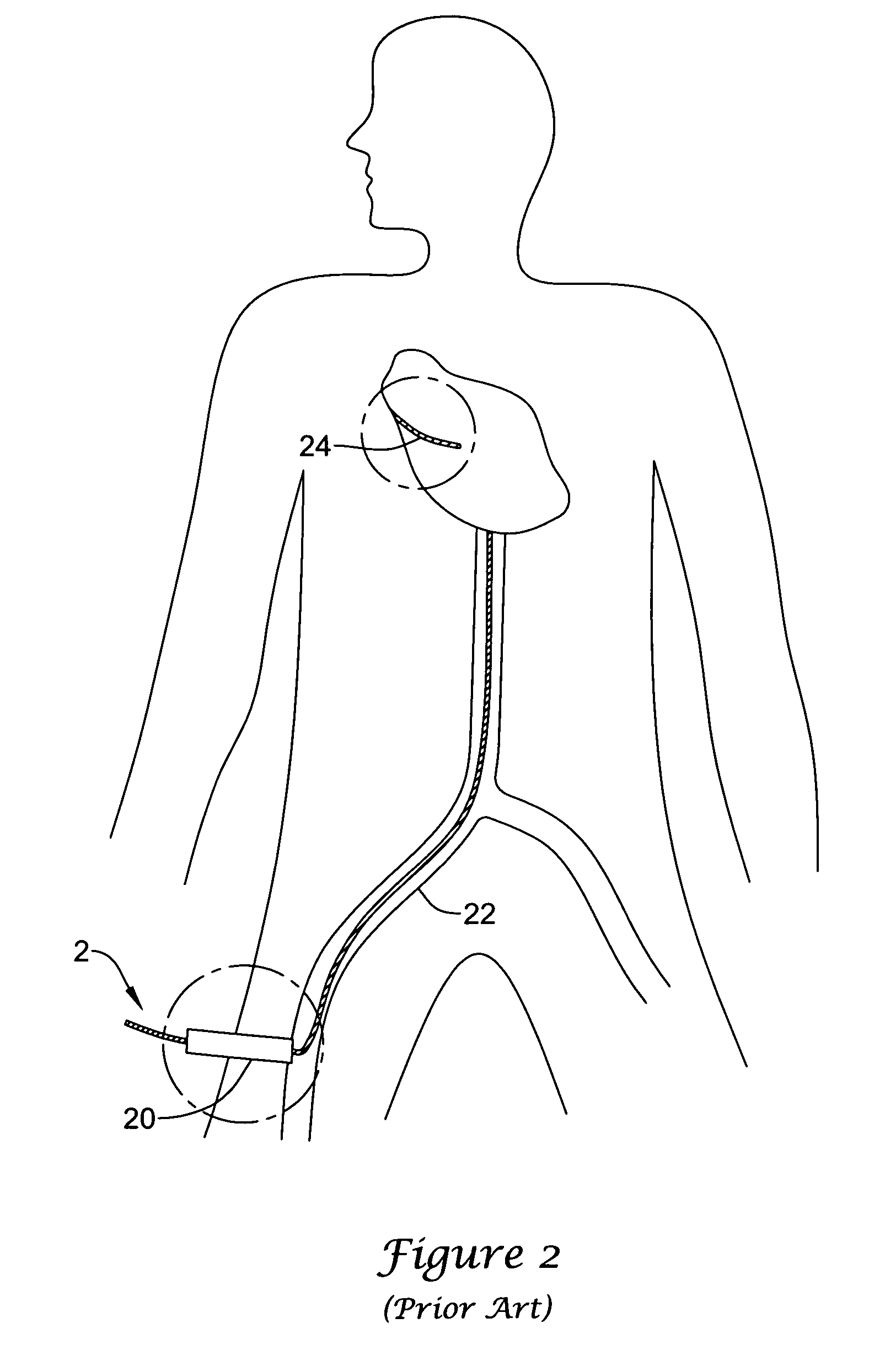Medical instrument with controlled torque transmission