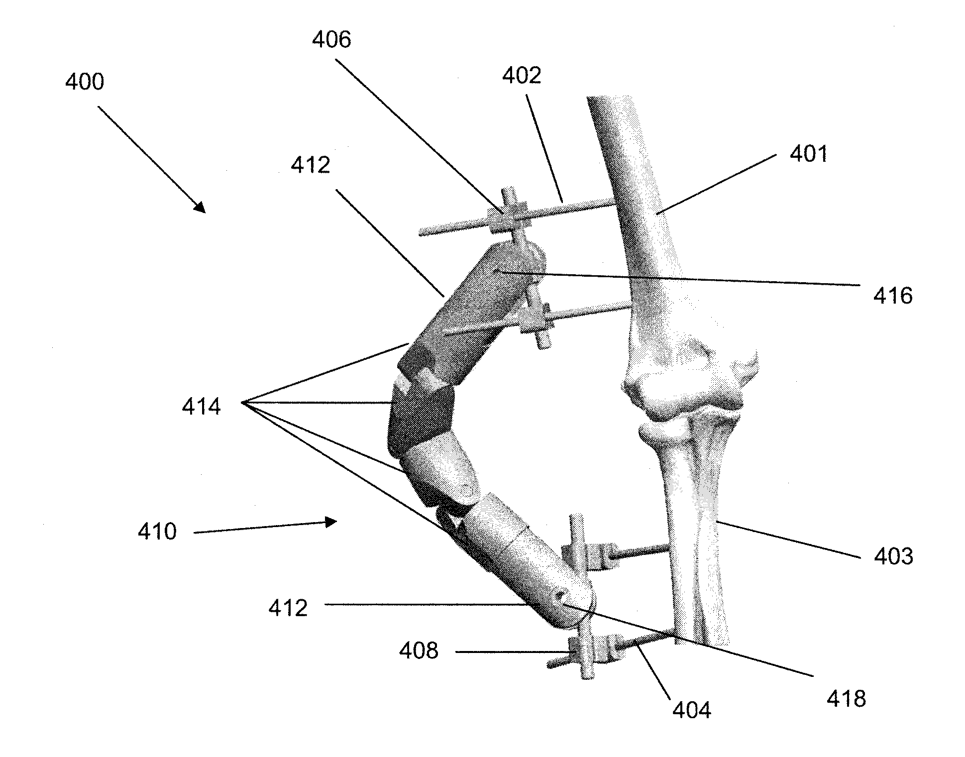 External fixation devices and methods of use