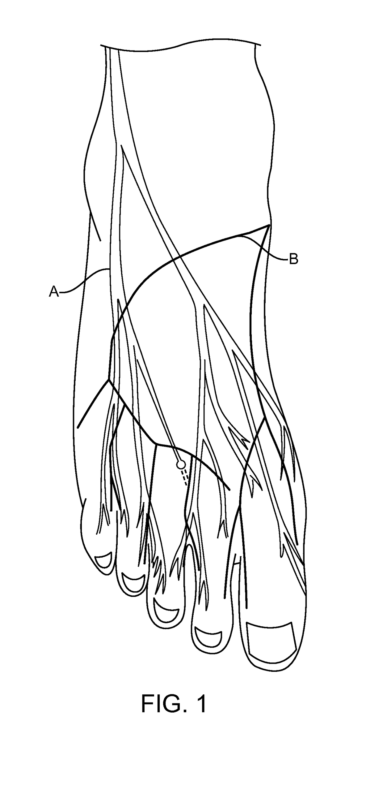 Methods and compositions for treating foot or hand pain