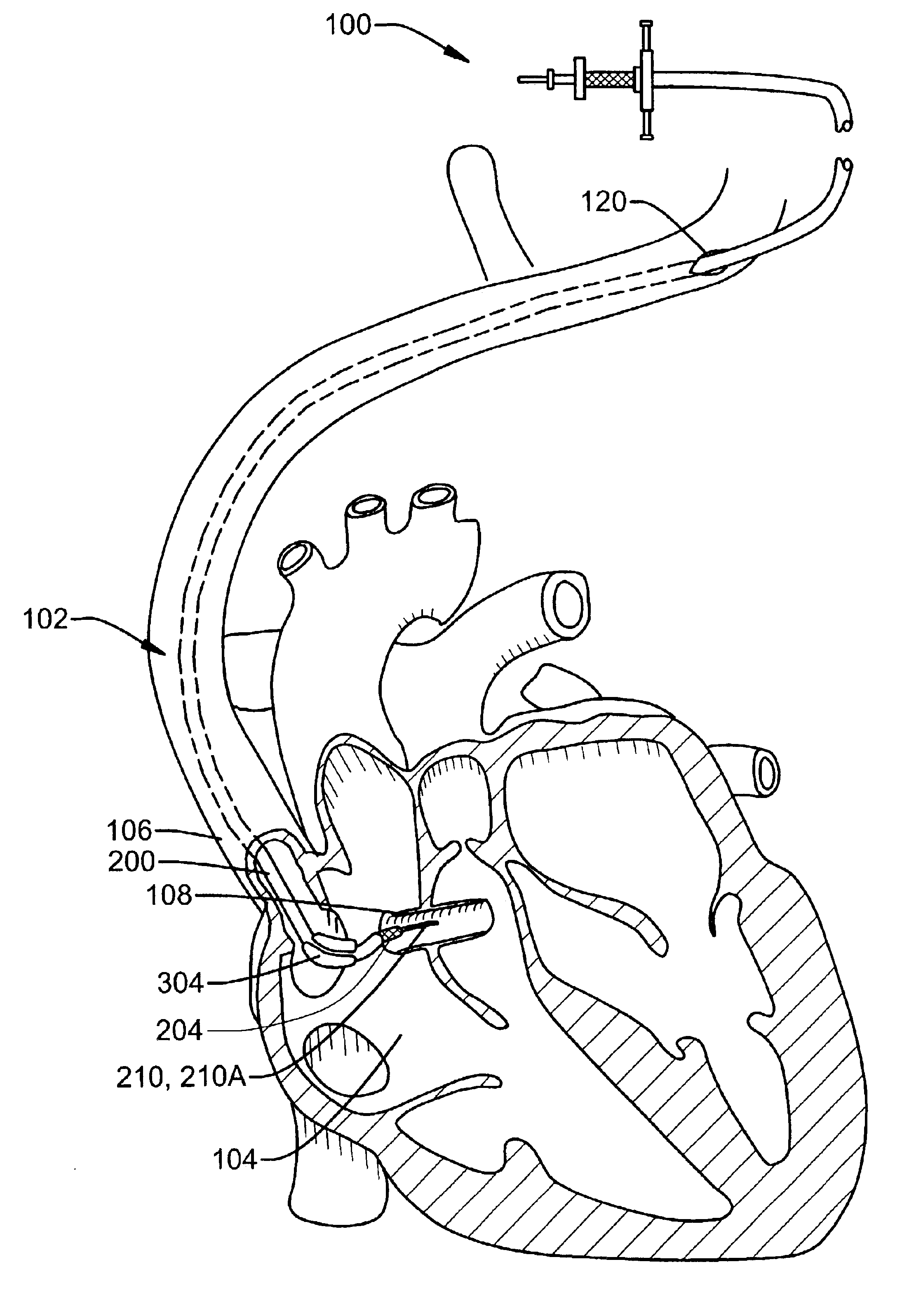 System and method for accessing the coronary sinus to facilitate insertion of pacing leads