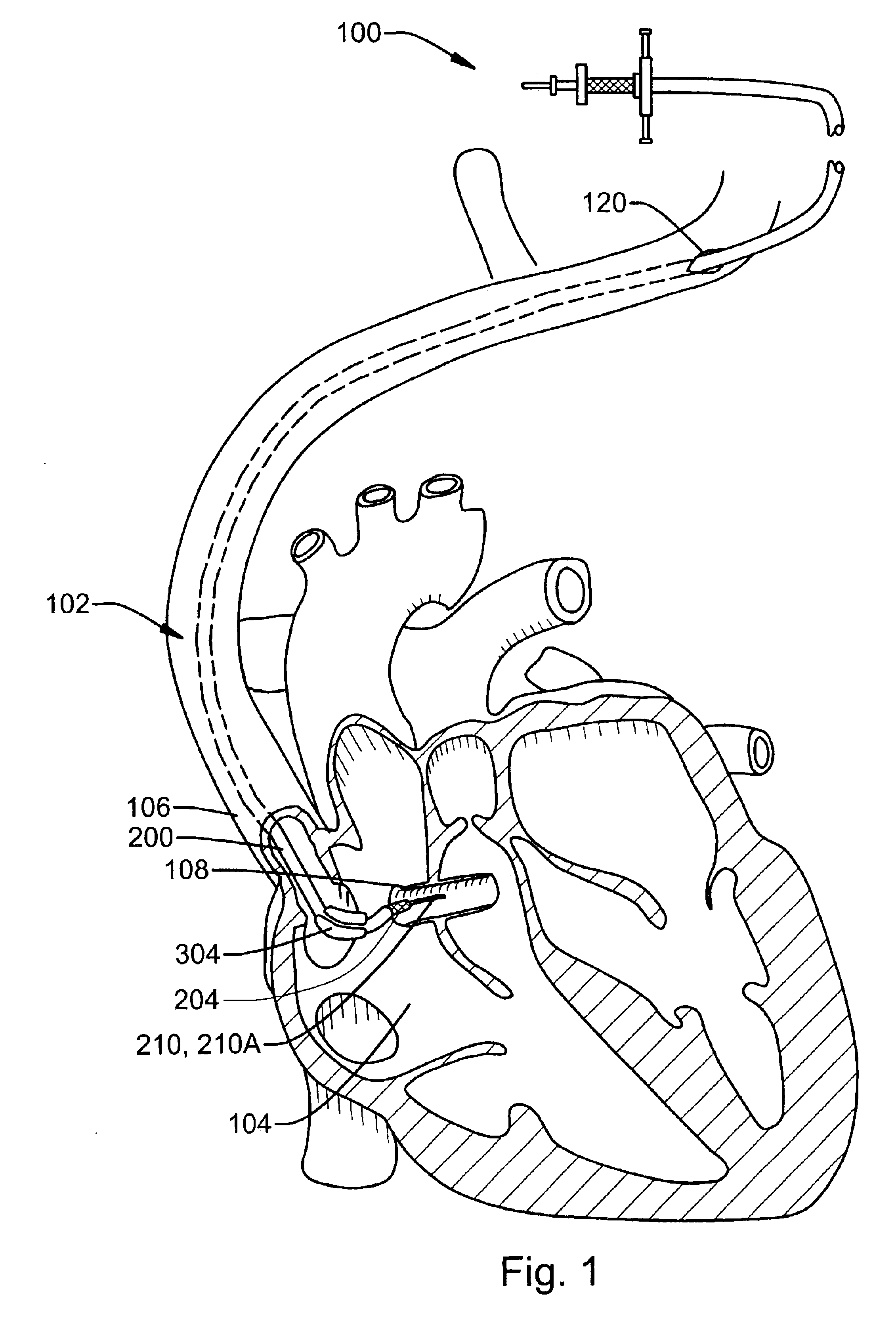 System and method for accessing the coronary sinus to facilitate insertion of pacing leads