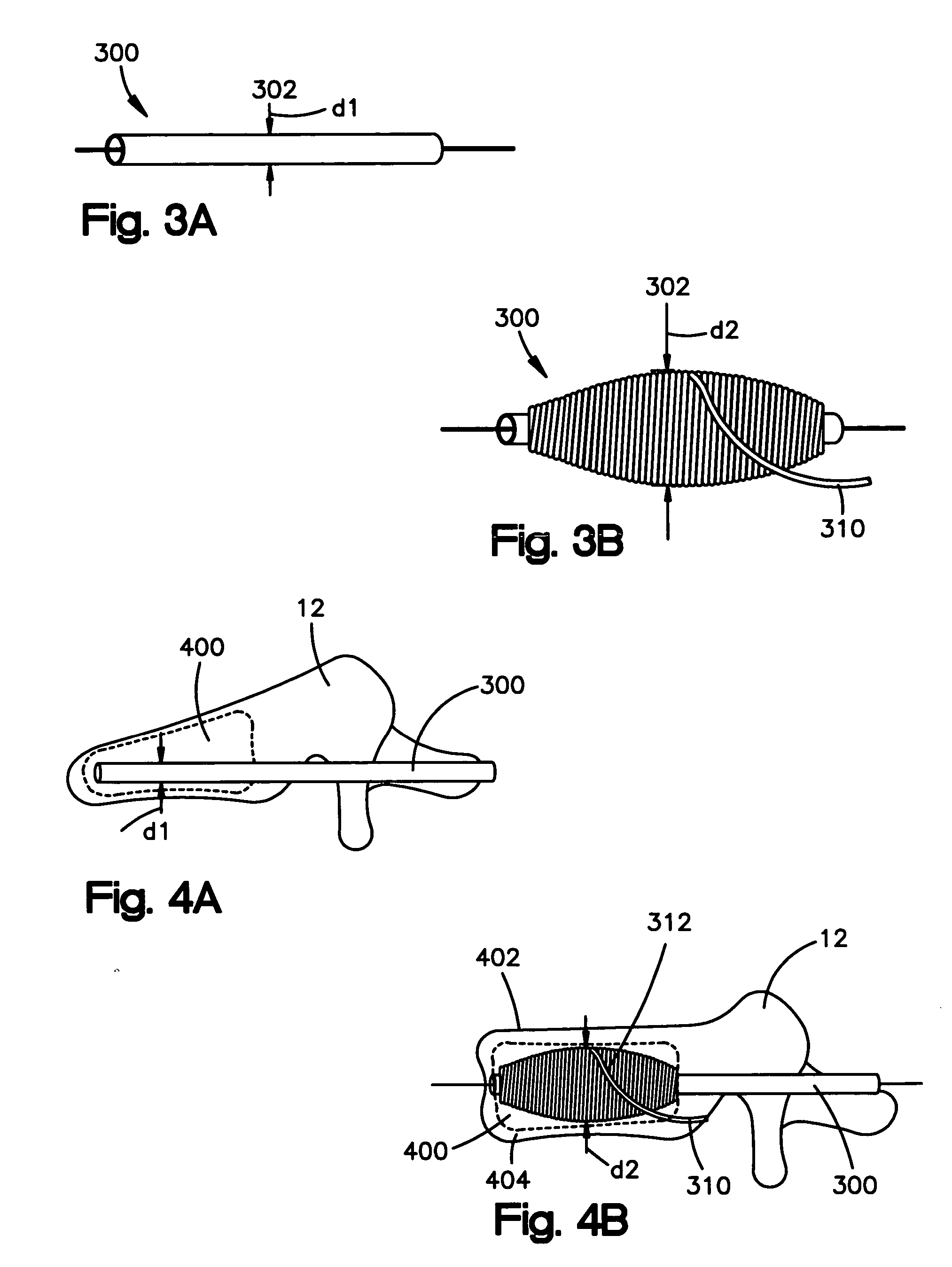 Apparatus and methods for treating bone