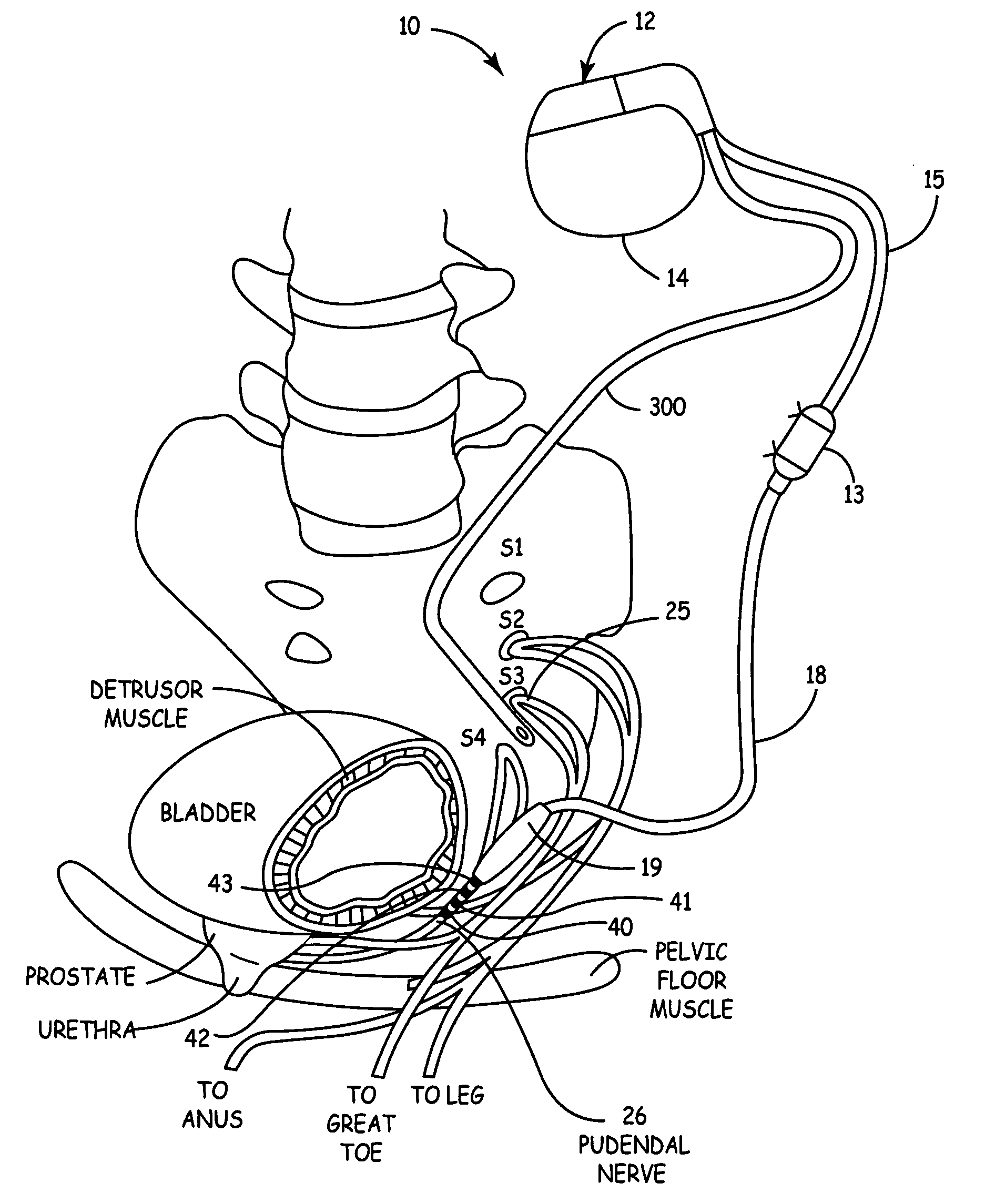 Method, system and device for treating disorders of the pelvic floor by electrical stimulation of and the delivery of drugs to the left and right pudendal nerves