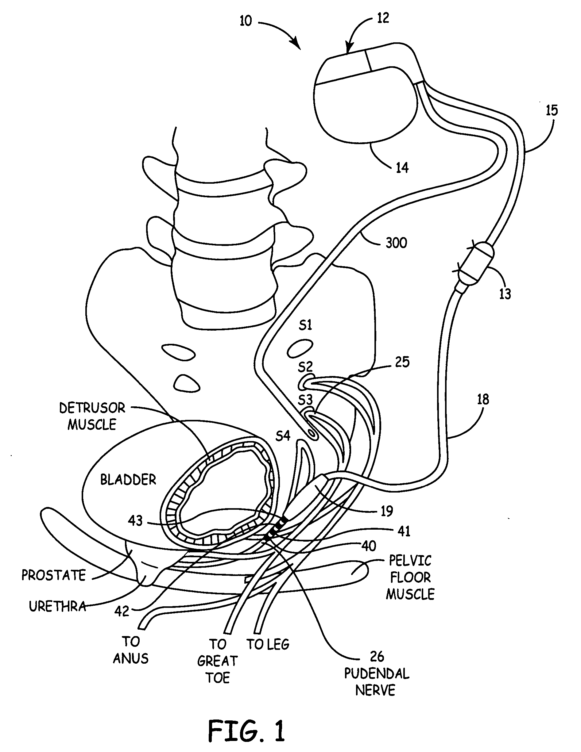 Method, system and device for treating disorders of the pelvic floor by electrical stimulation of and the delivery of drugs to the left and right pudendal nerves