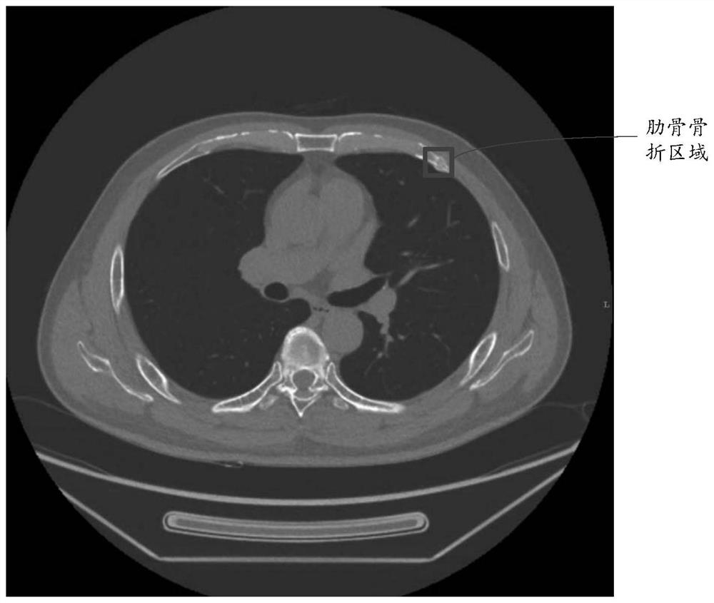 CT rib fracture auxiliary diagnosis system based on deep learning algorithm