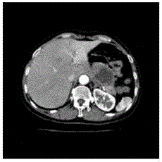 Liver multi-phase CT image fusion method