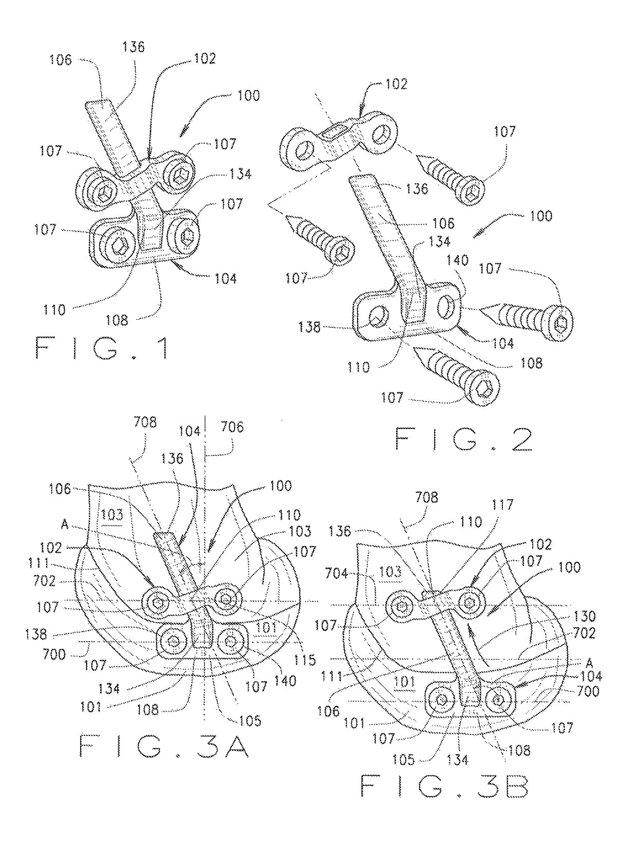 Orthopedic apparatus for correcting rotational bone deformities and method for using the orthopedic apparatus