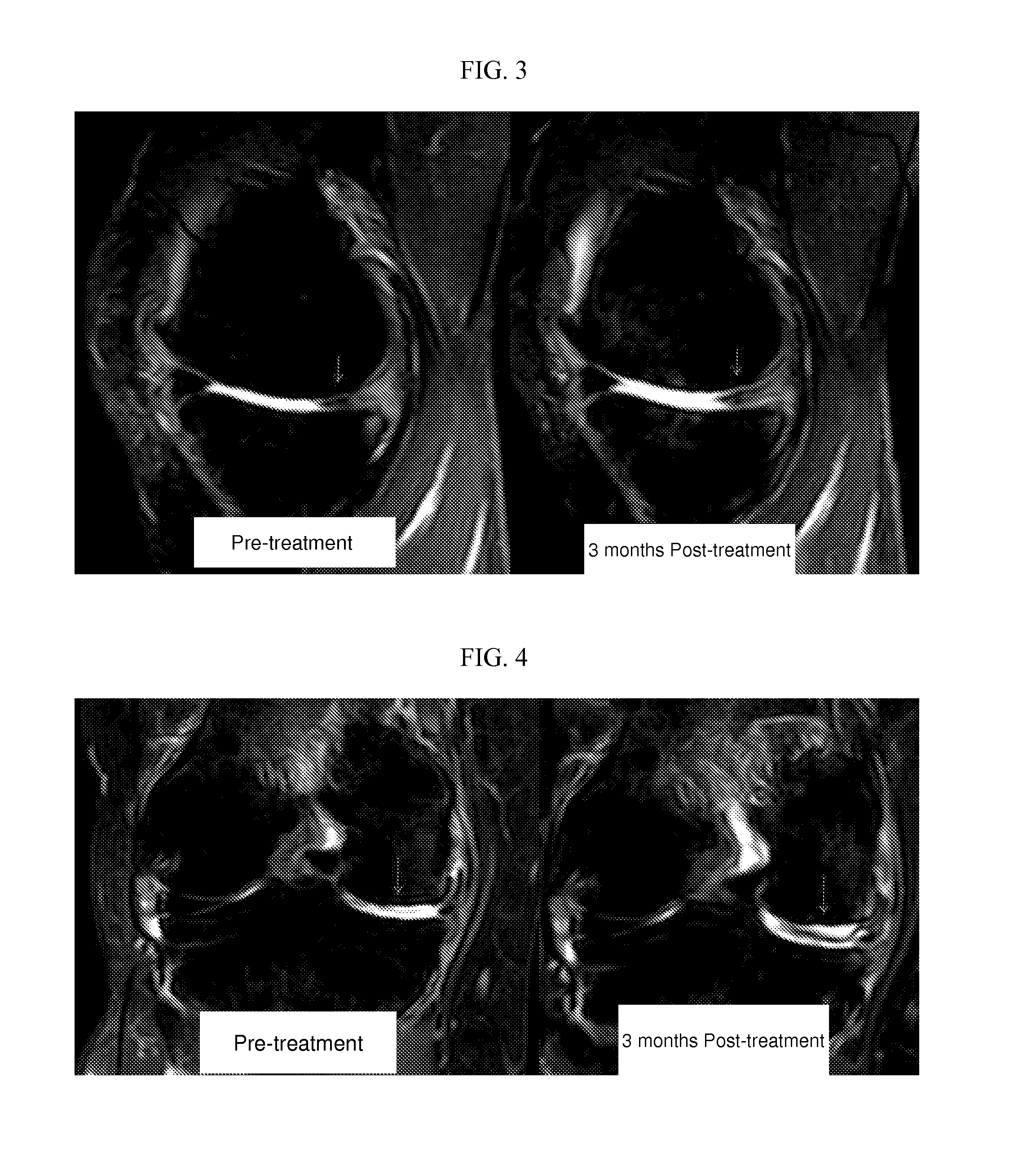 Compositions and methods for treating, preventing, or alleviating bone or cartilage diseases