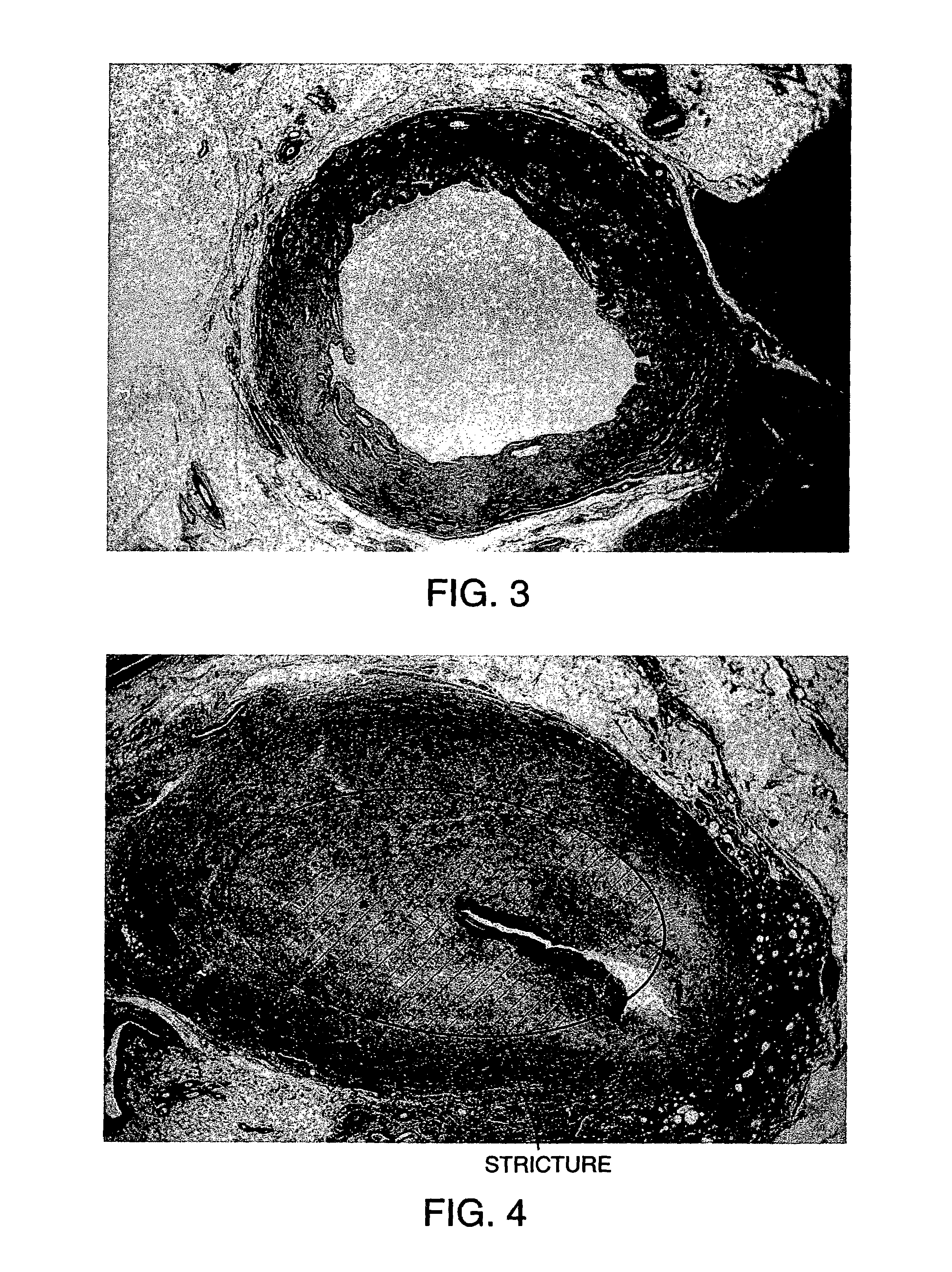 Methods for treating an artery or vein in a human subject
