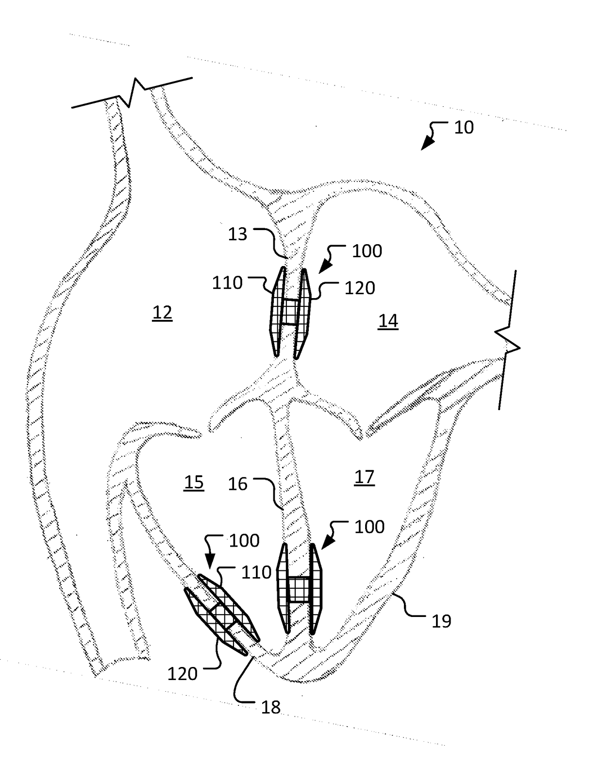Devices and methods for cardiac pacing and resynchronization