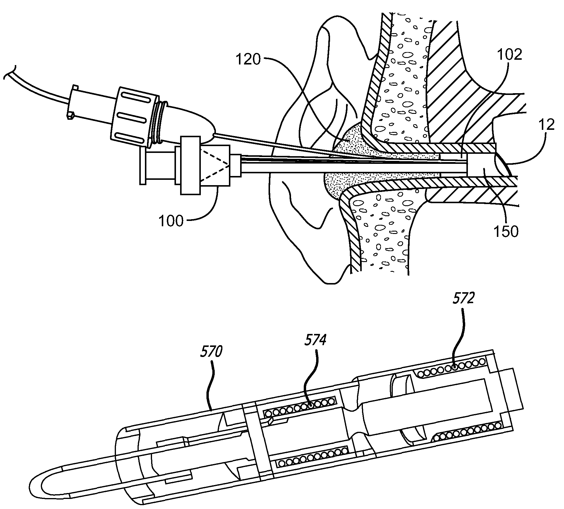 System and method for the simultaneous automated bilateral delivery of pressure equalization tubes